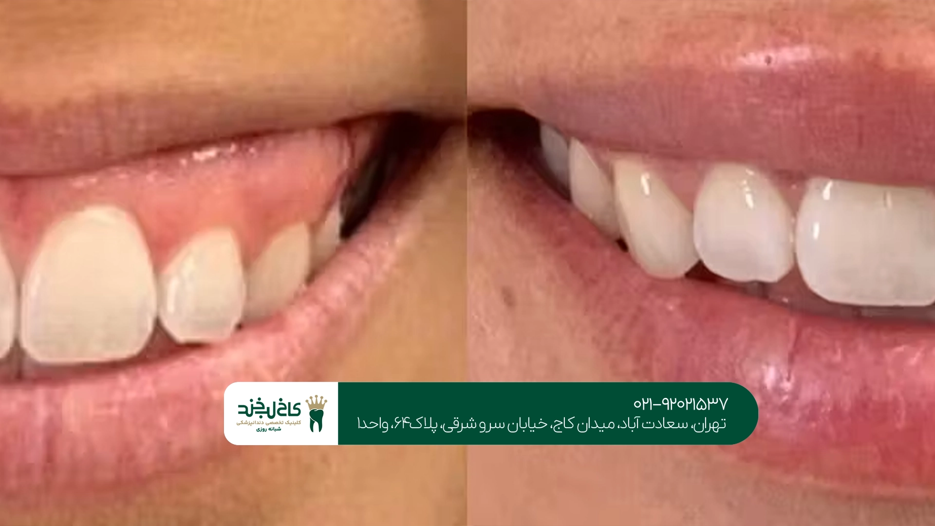 متخصص جراحی لثه برای زیبایی لبخند