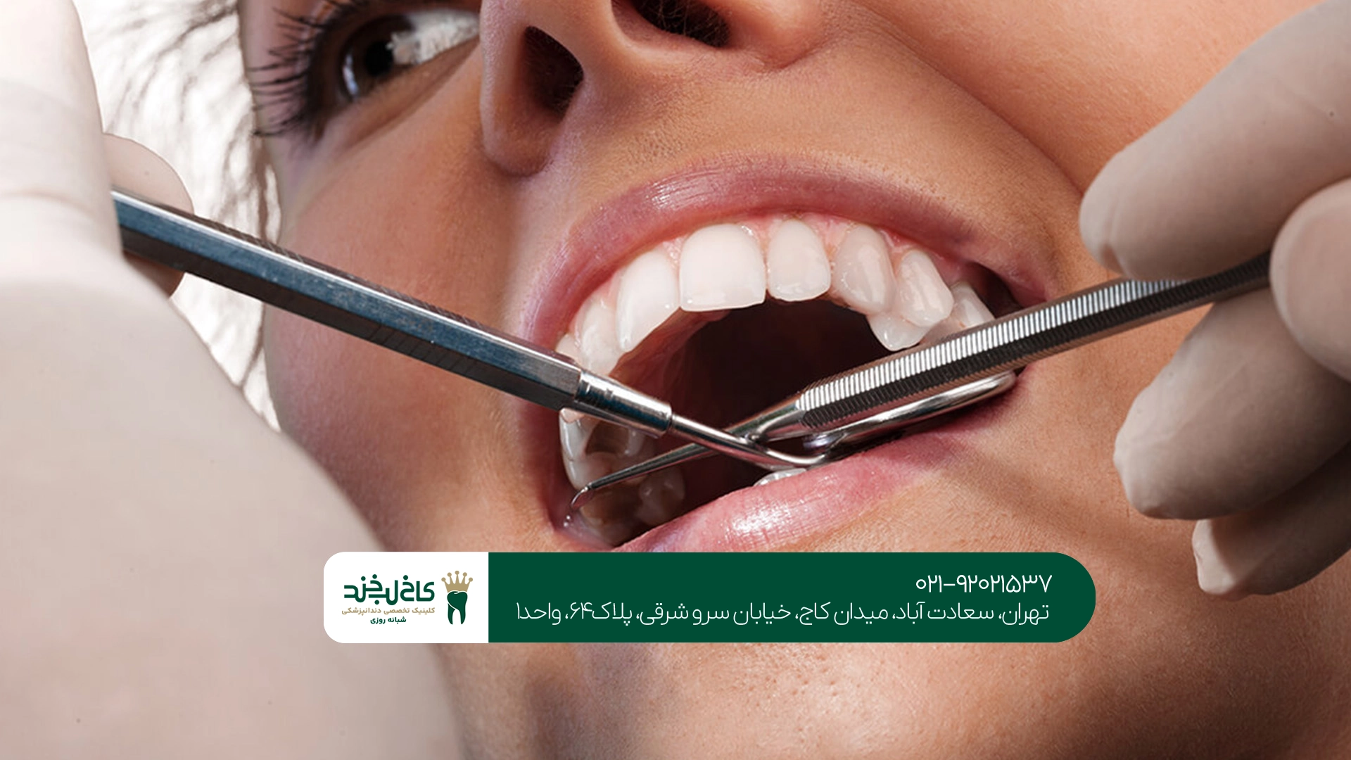 جرم گیری دندان جرم گیری دندان