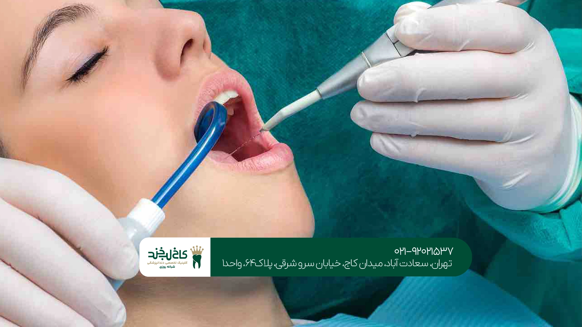 جرم گیری دندان در تهران جرم گیری دندان در تهران