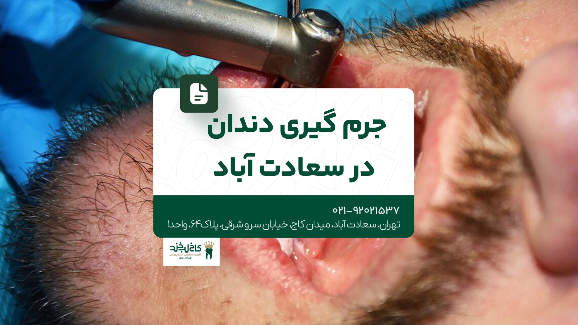 جرم گیری دندان در سعادت آباد جرم گیری دندان در سعادت آباد