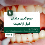 جرم گیری دندان قبل از لمینت