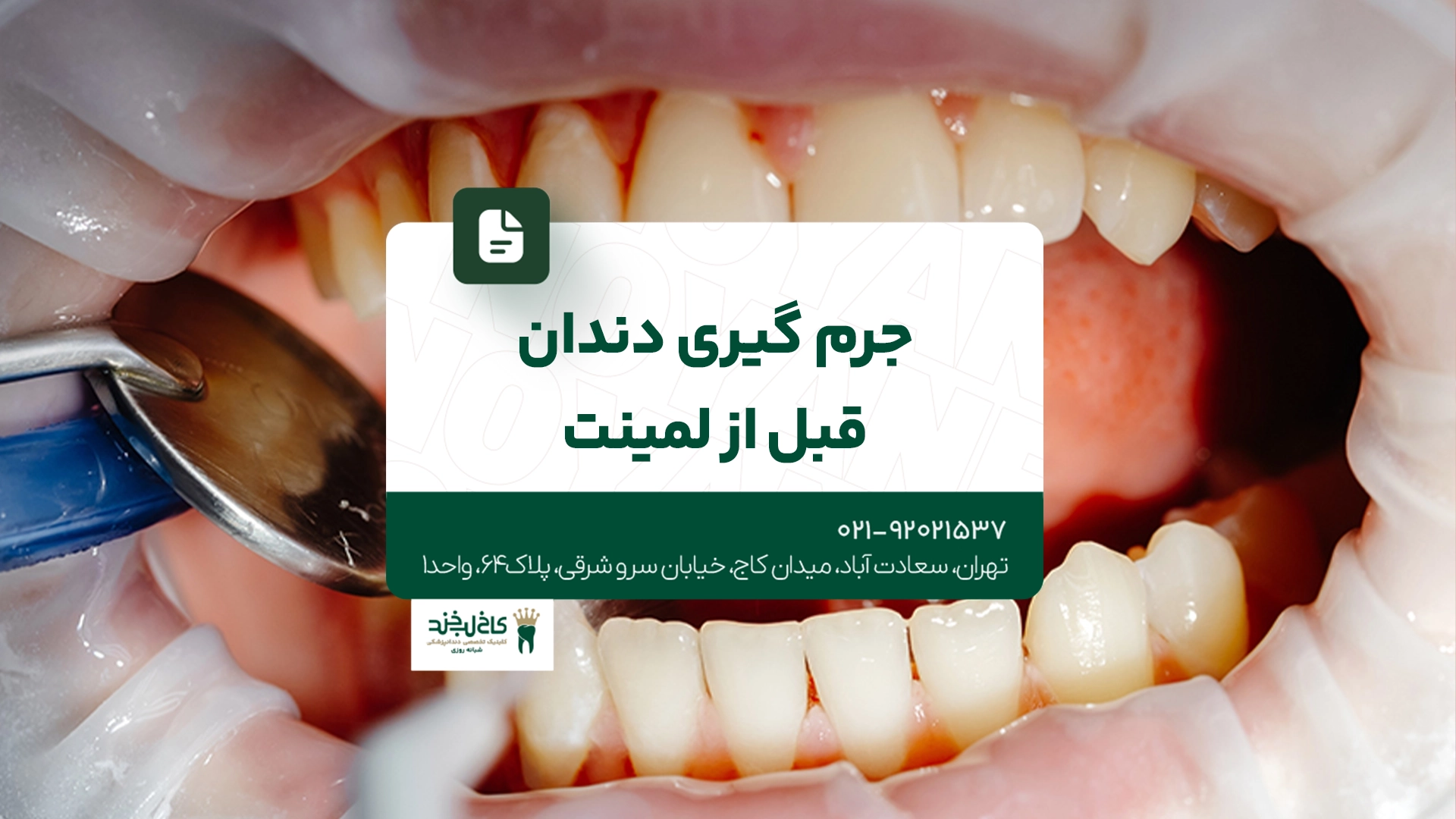 جرم گیری دندان قبل از لمینت جرم گیری دندان قبل از لمینت