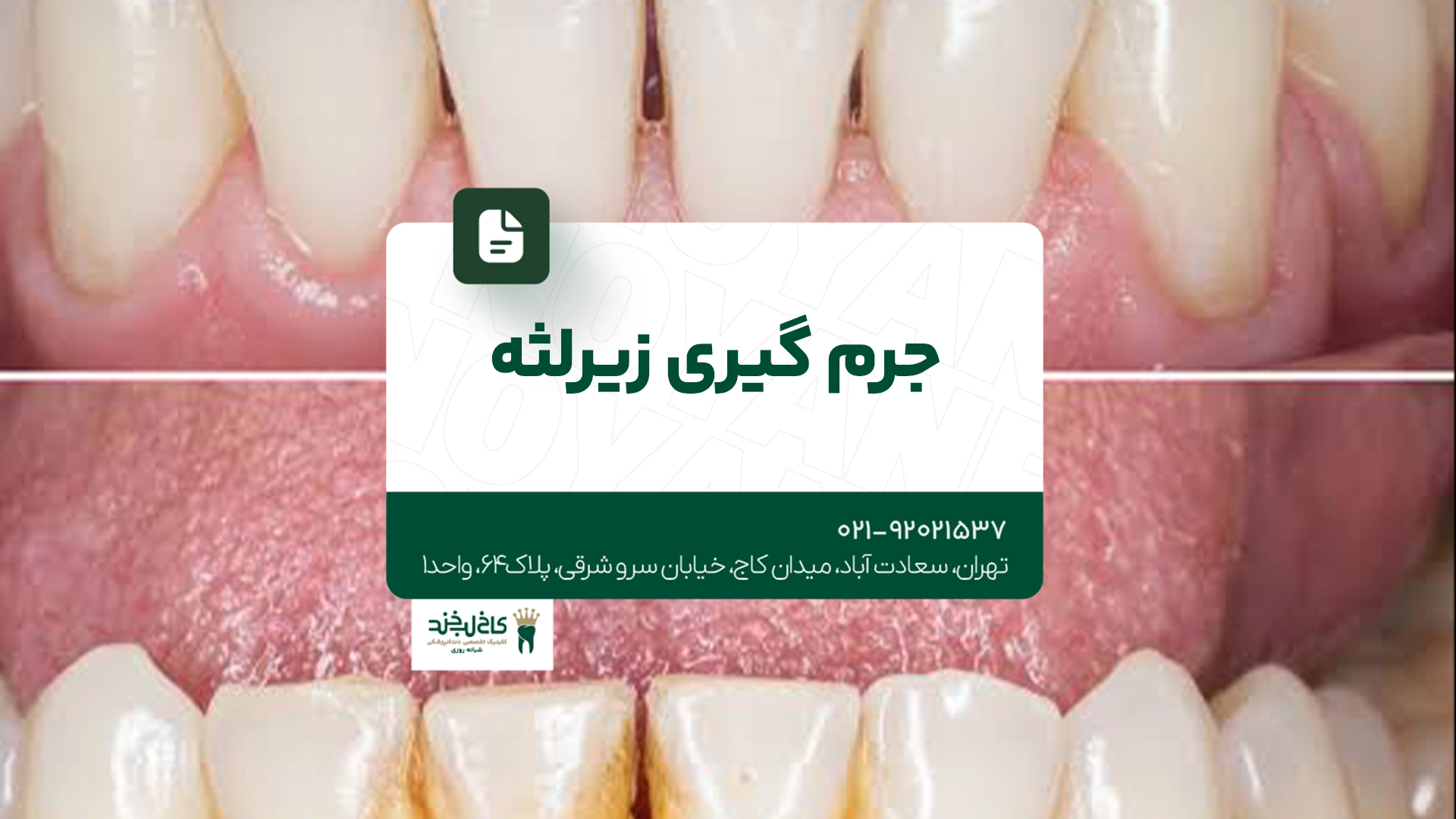 جرم گیری زیر لثه
