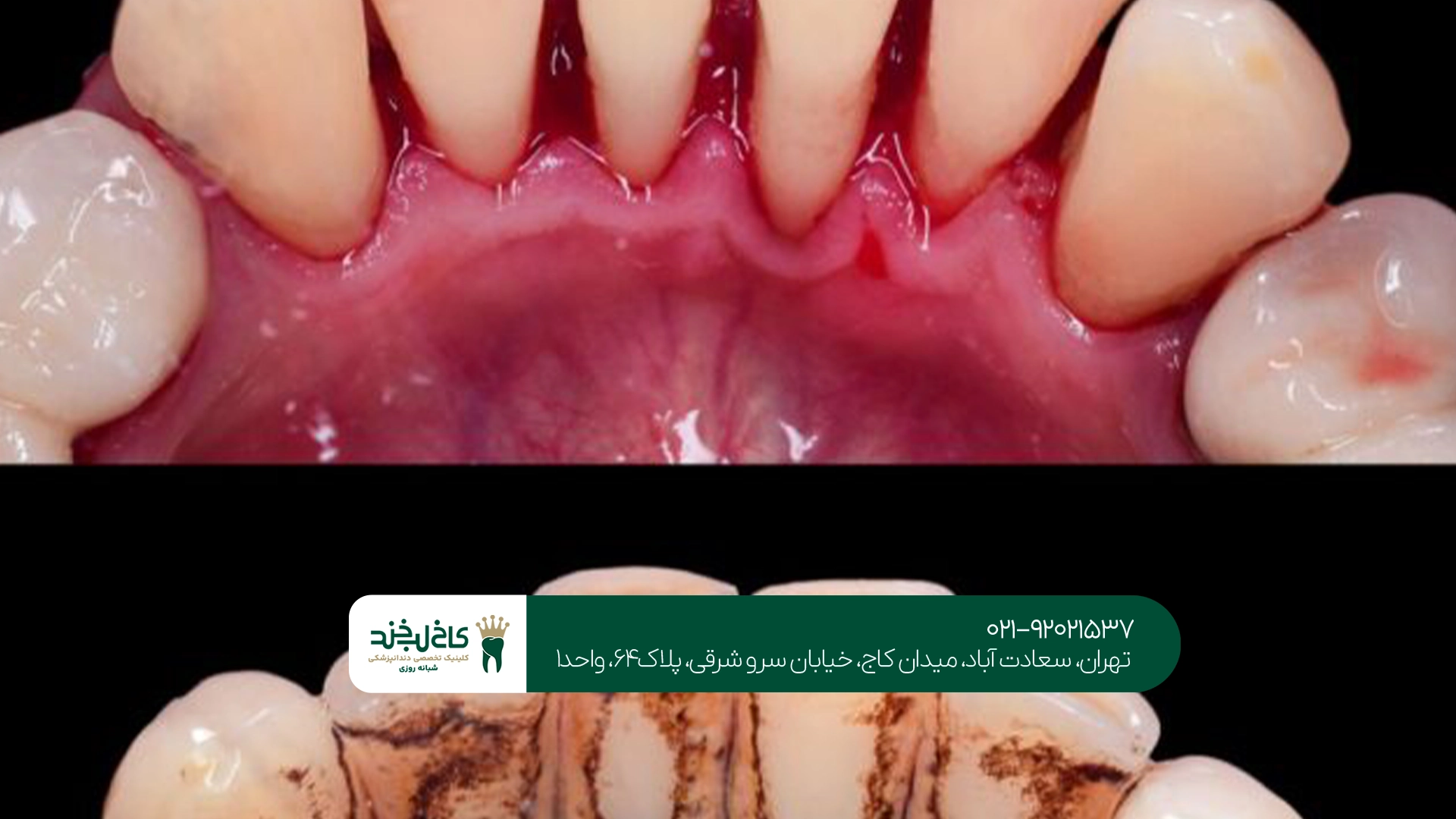 بهترین مرکز جرم گیری زیر لثه