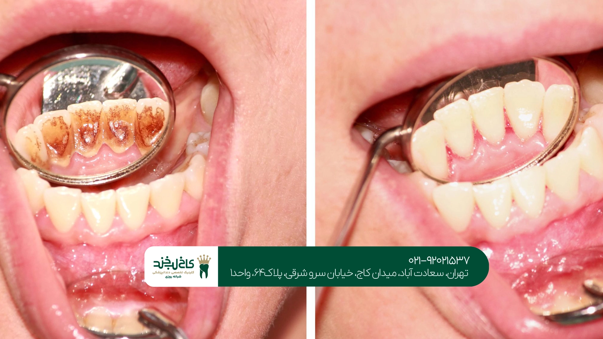 مراقبتهای بعد از جرم گیری زیر لثه