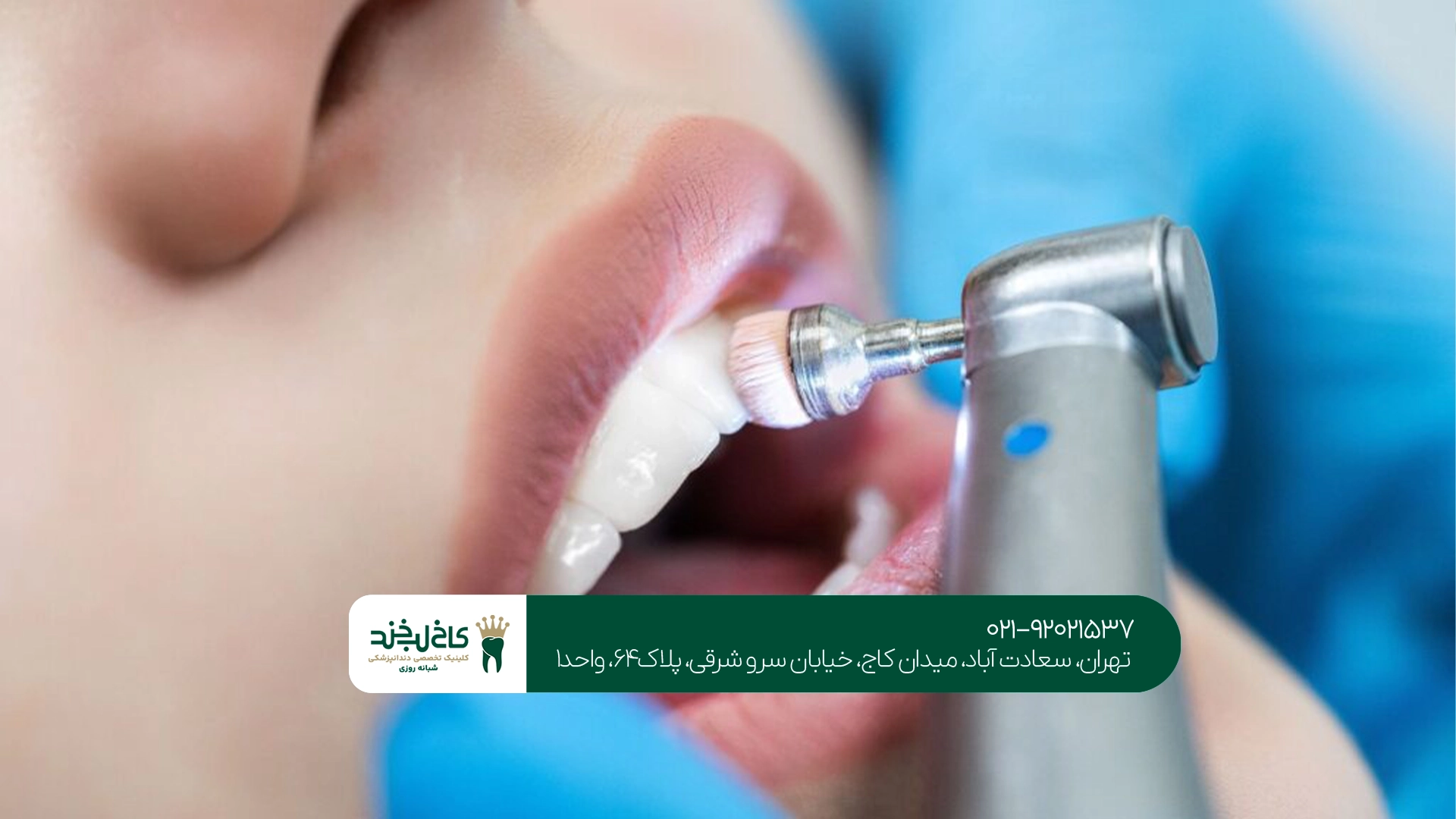 جرمگیری دندان چه کاربردی دارد؟ جرمگیری دندان چه کاربردی دارد؟