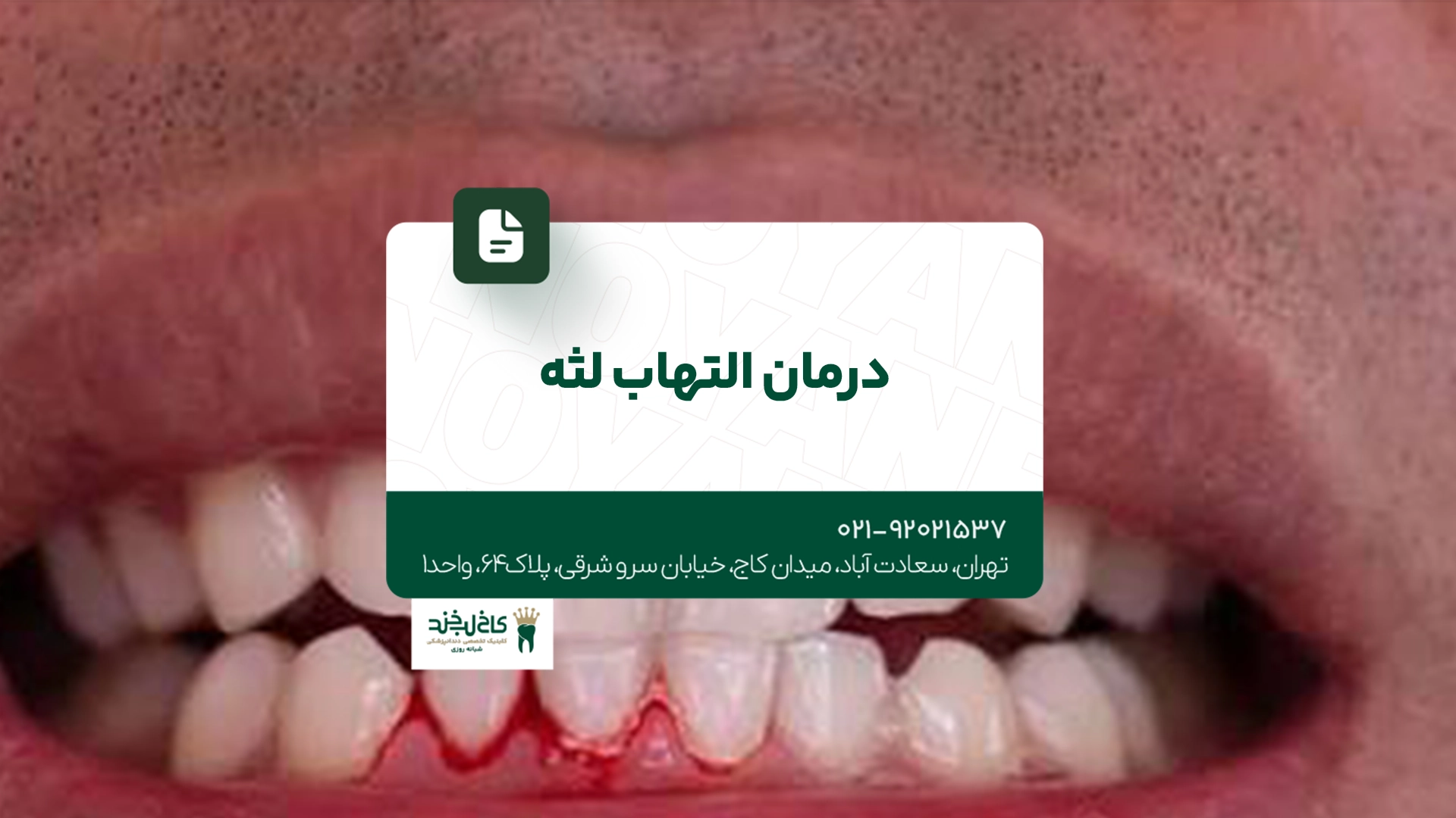 درمان التهاب لثه