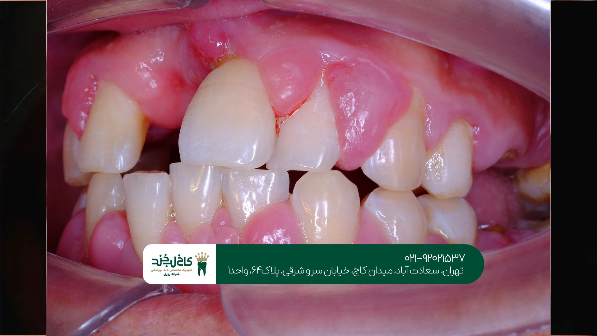 بهترین روشهای درمان التهاب لثه چیست؟