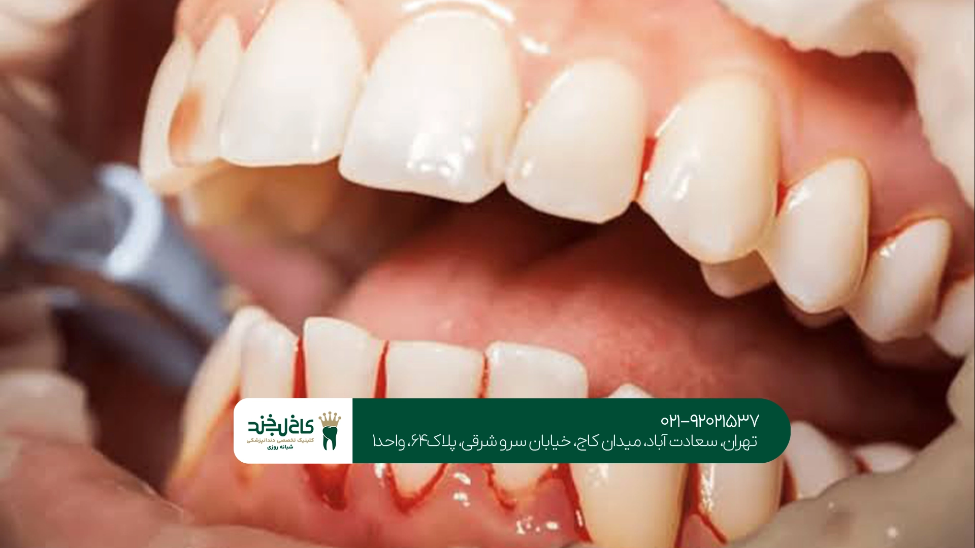 متخصص درمان التهاب لثه