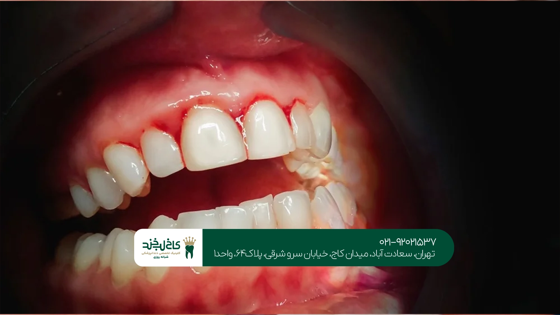 آیا التهاب لثه بدون جراحی درمان میشود؟