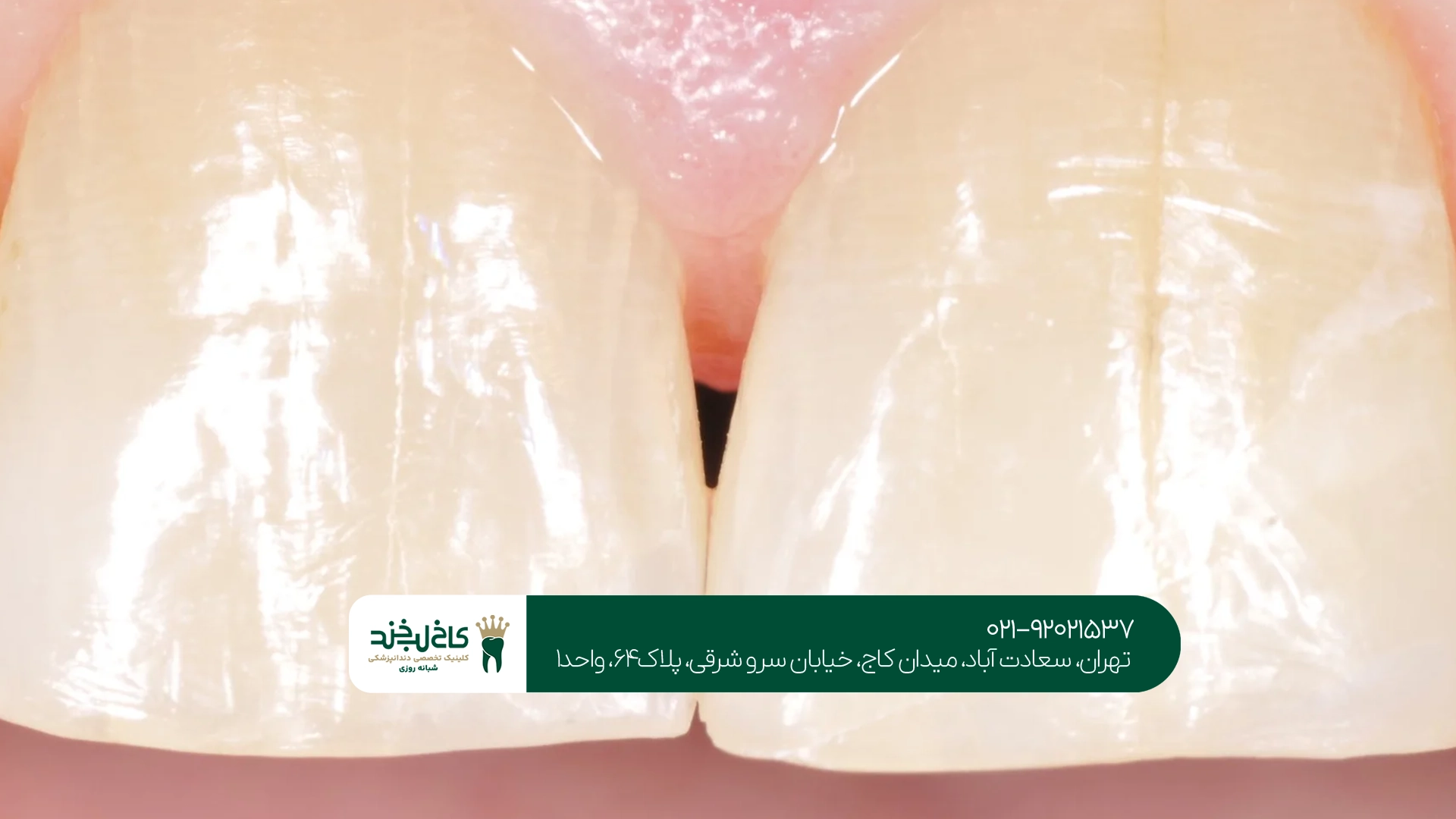 متخصص درمان ترک خوردگی دندان