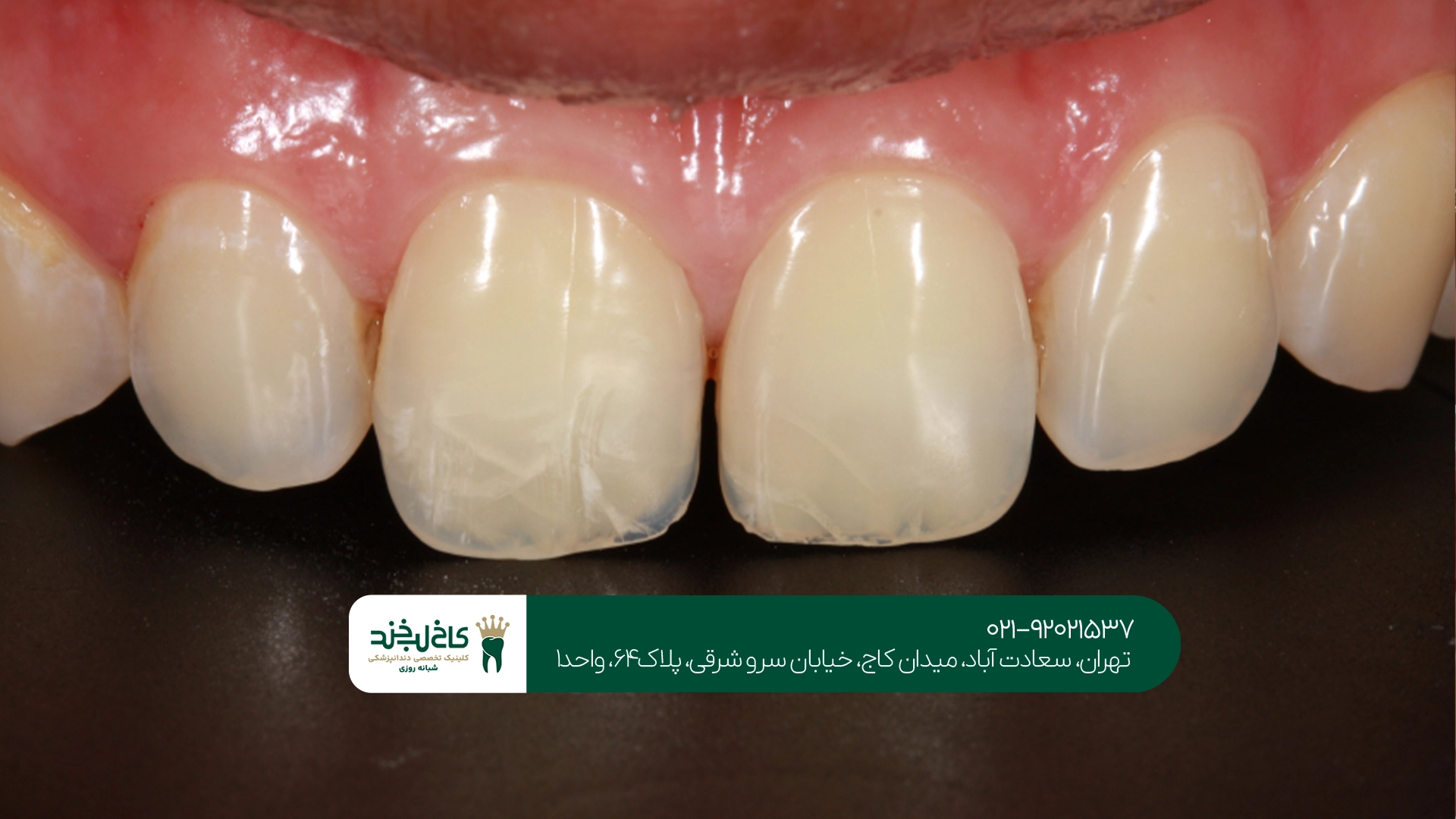 چگونه از ترک خوردگی دندان جلوگیری کنیم؟