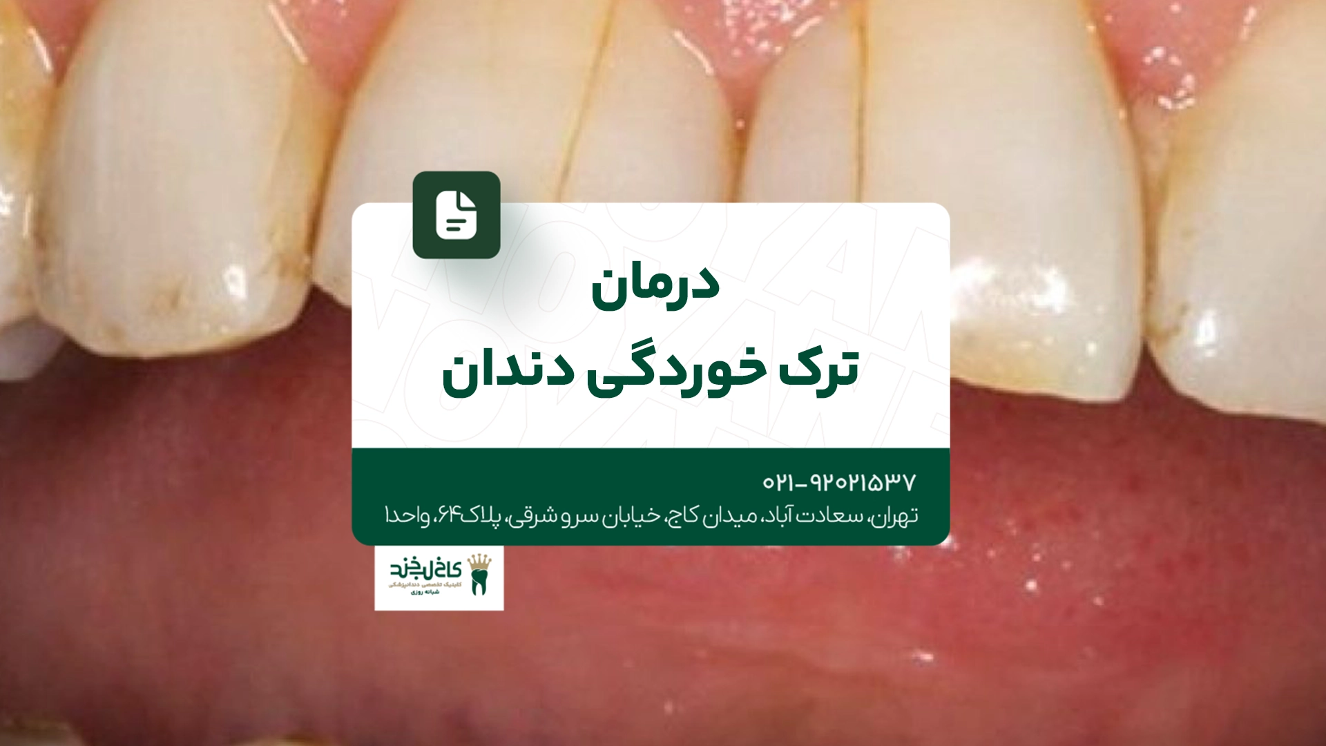 درمان ترک خوردگی دندان