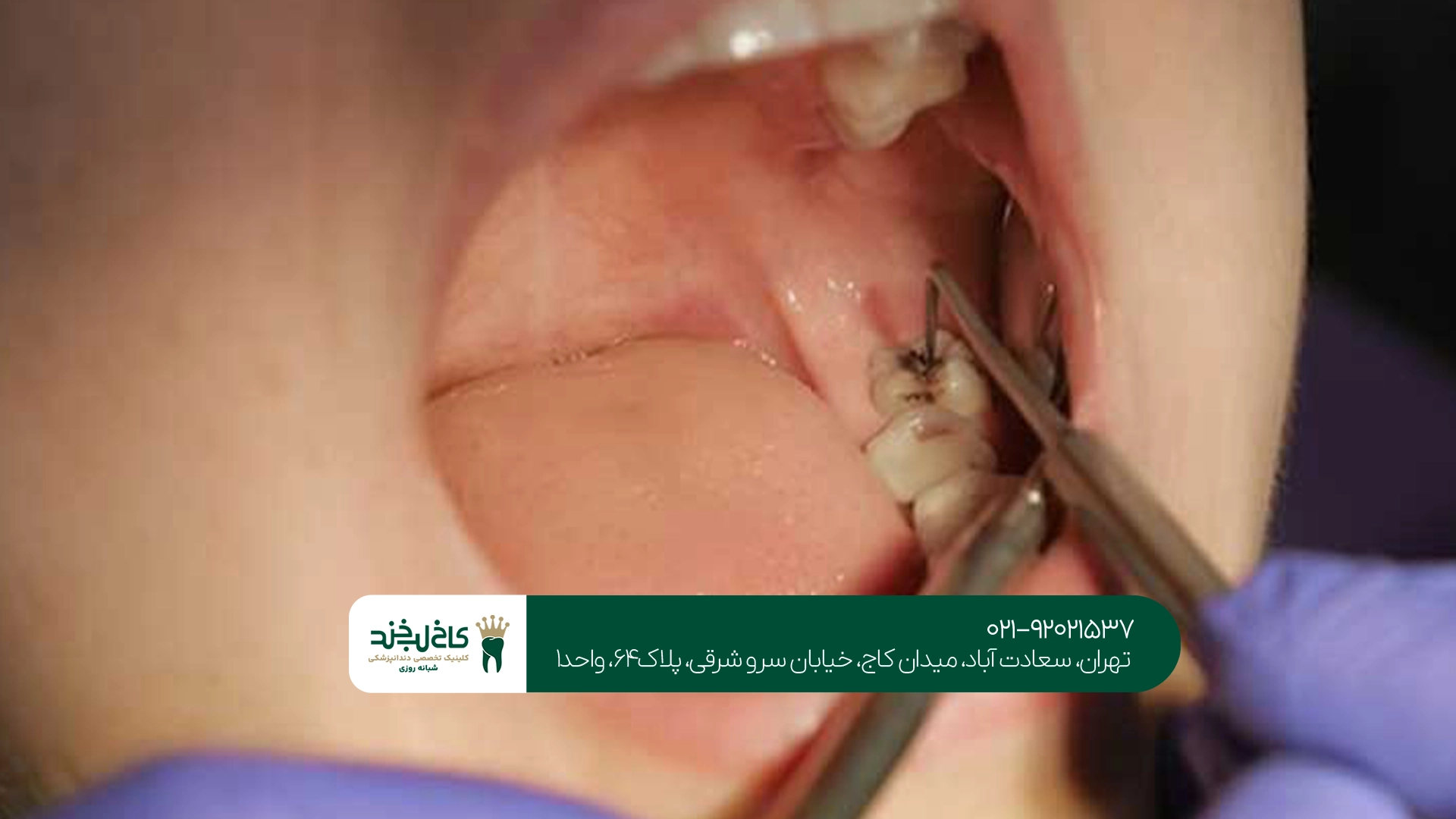 متخصص درمان دندان بدون درد