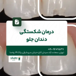 درمان شکستگی دندان جلو