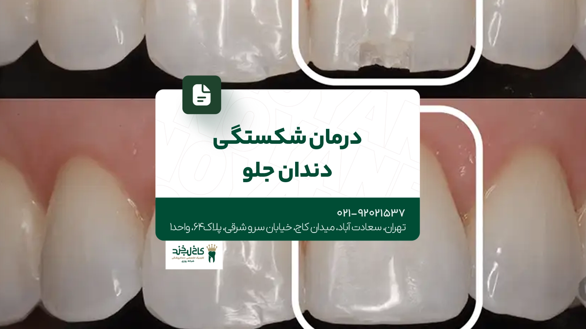 درمان شکستگی دندان جلو