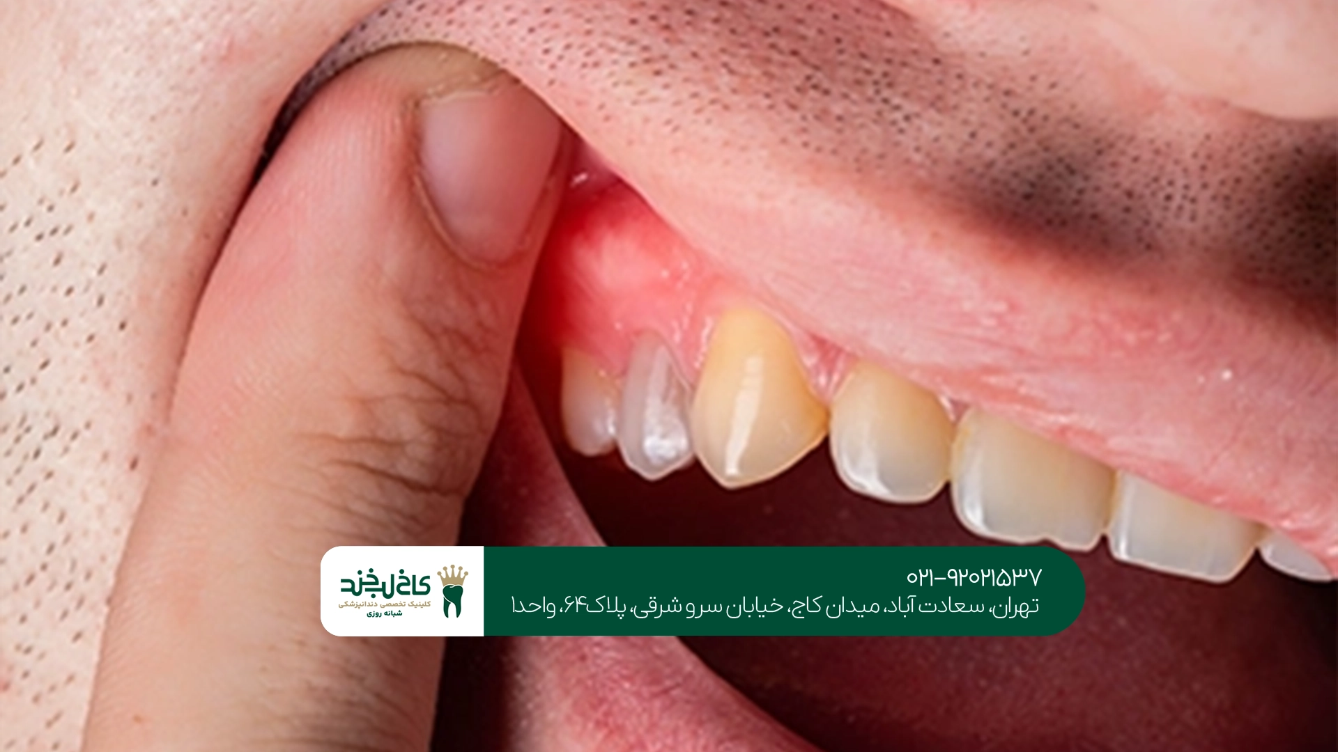 درمان ریشه دندان در تهران درمان ریشه دندان در تهران
