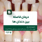 درمان فاصله بین دندانها