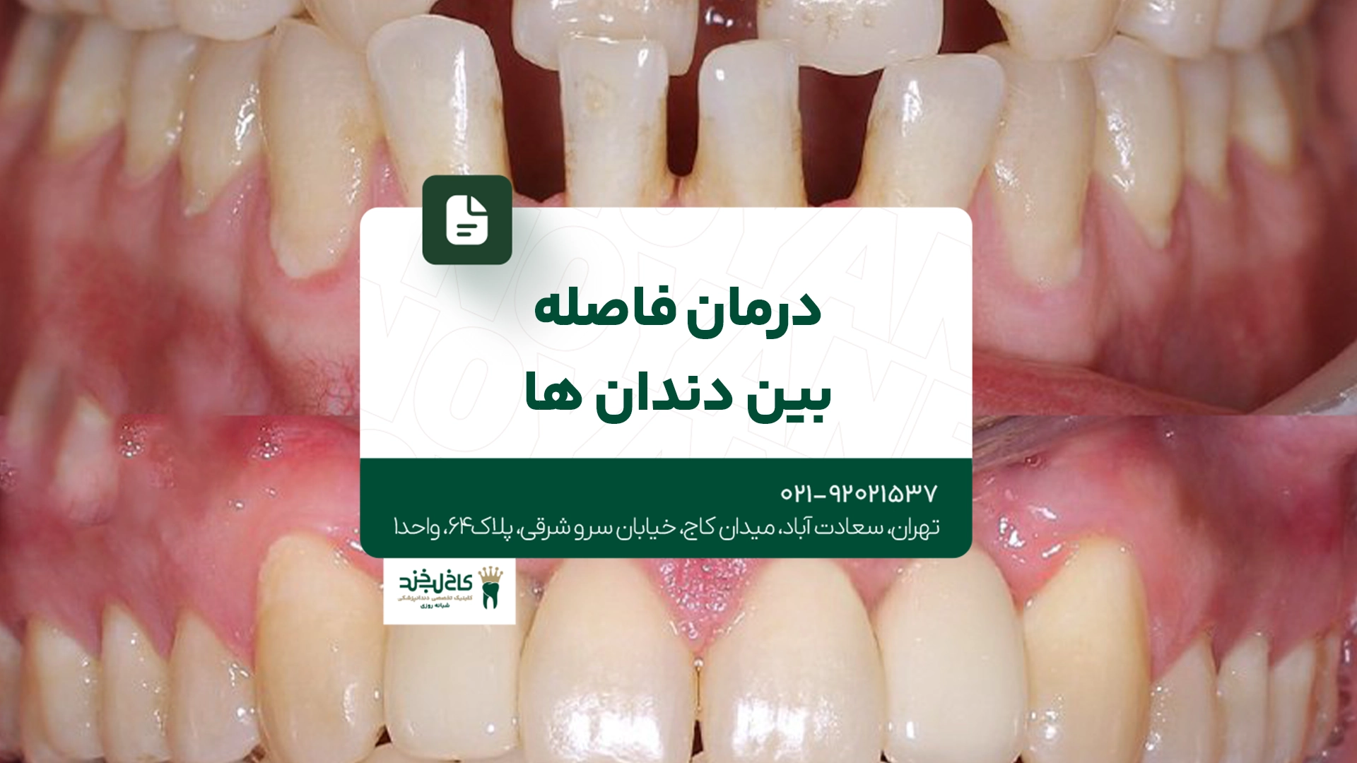 درمان فاصله بین دندانها