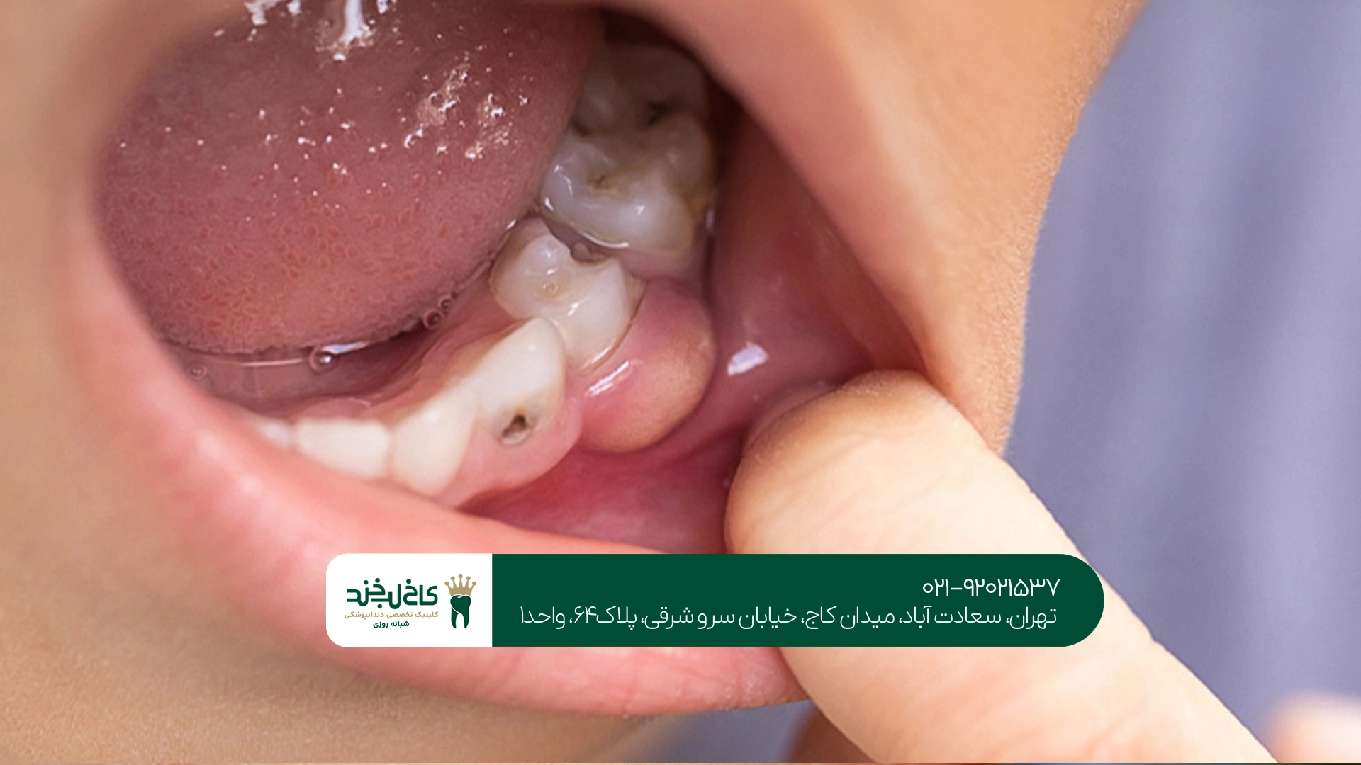 درمان فوری آبسه دندان چگونه انجام میشود؟