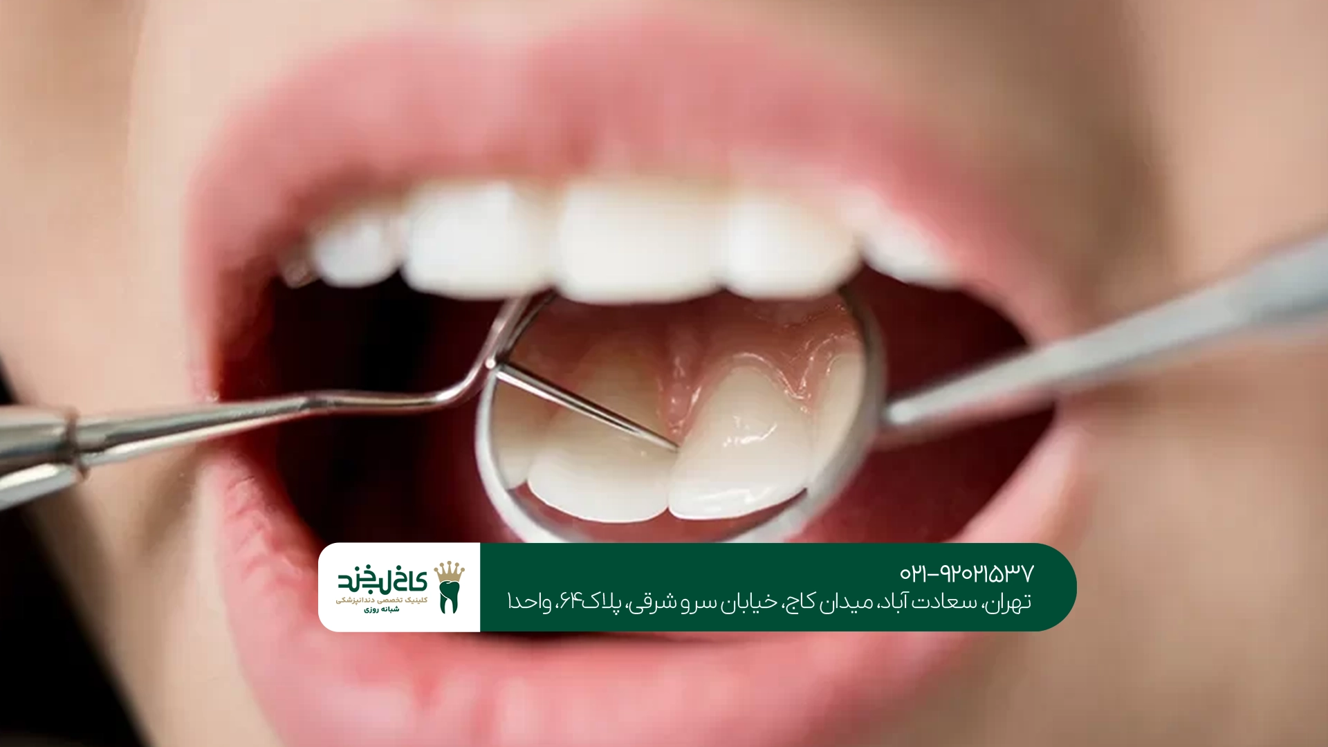 درمان پلاک دندان در تهران درمان پلاک دندان در تهران