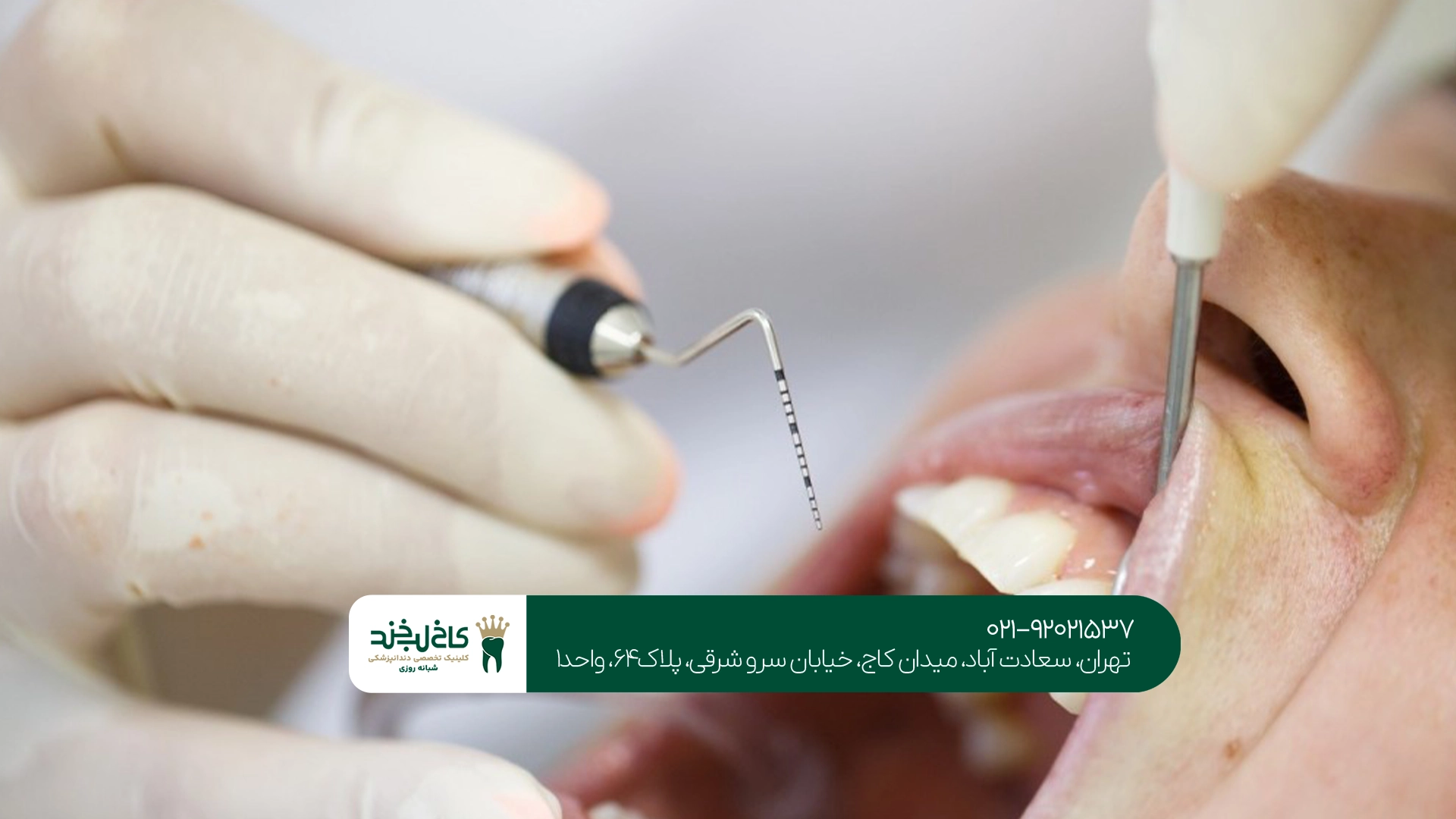 تفاوت پلاک دندان و جرم دندان چیست؟ تفاوت پلاک دندان و جرم دندان چیست؟