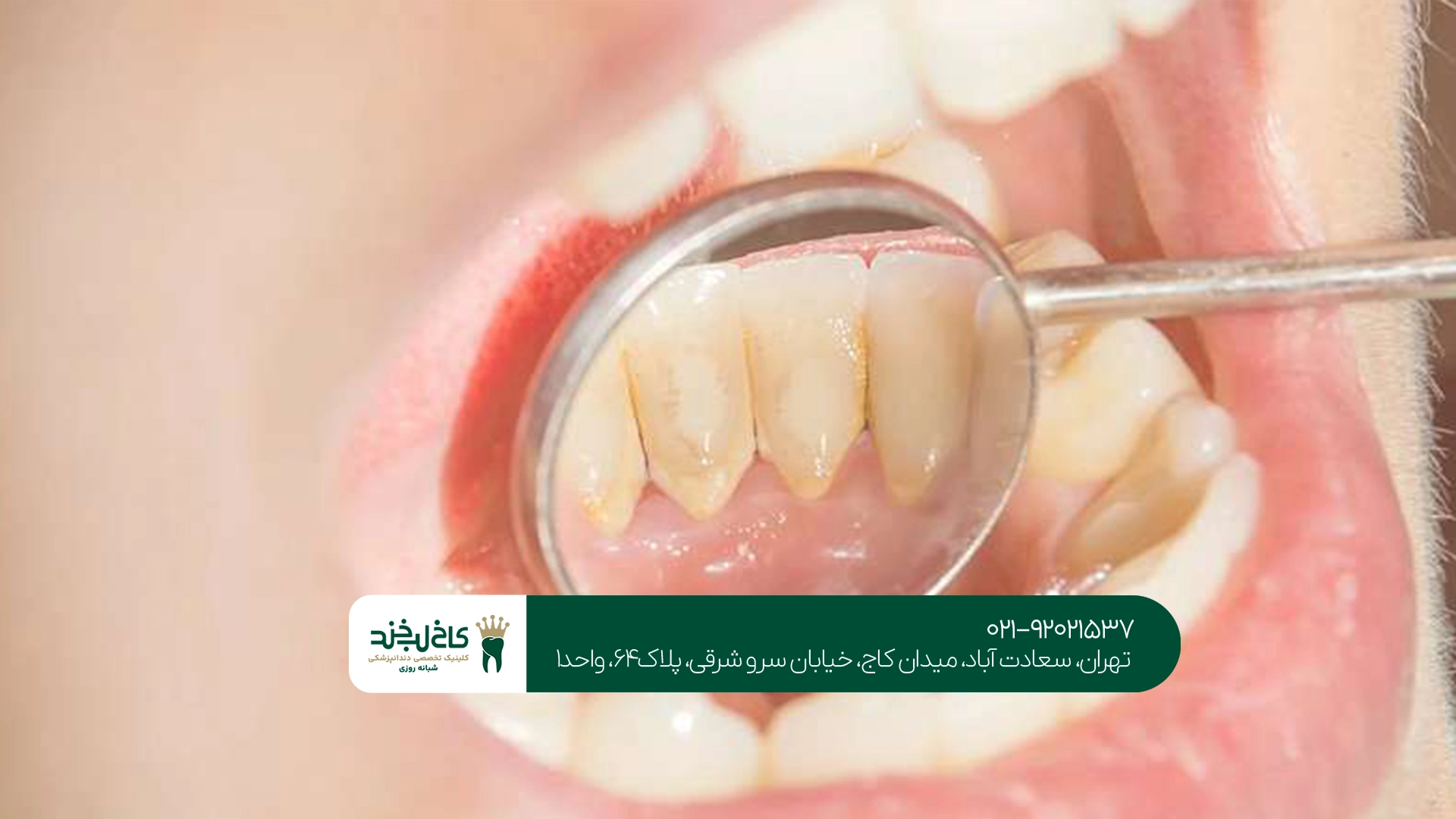 علائم پلاک دندان را چگونه تشخیص دهیم؟ علائم پلاک دندان را چگونه تشخیص دهیم؟