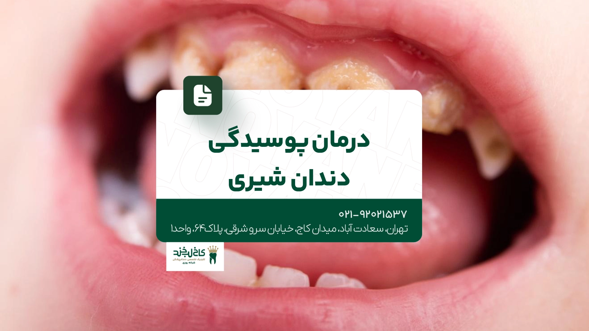 درمان پوسیدگی دندان شیری