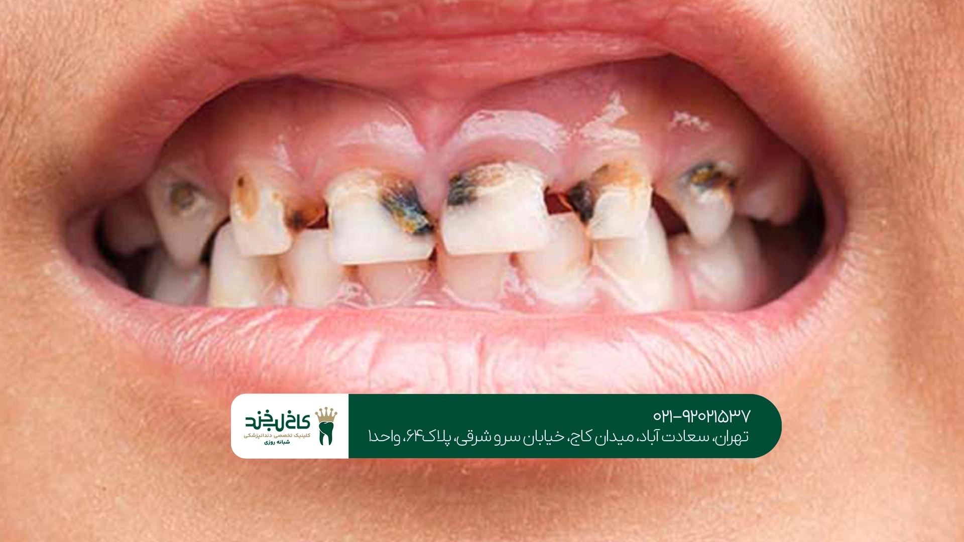 بهترین زمان درمان پوسیدگی دندان شیری