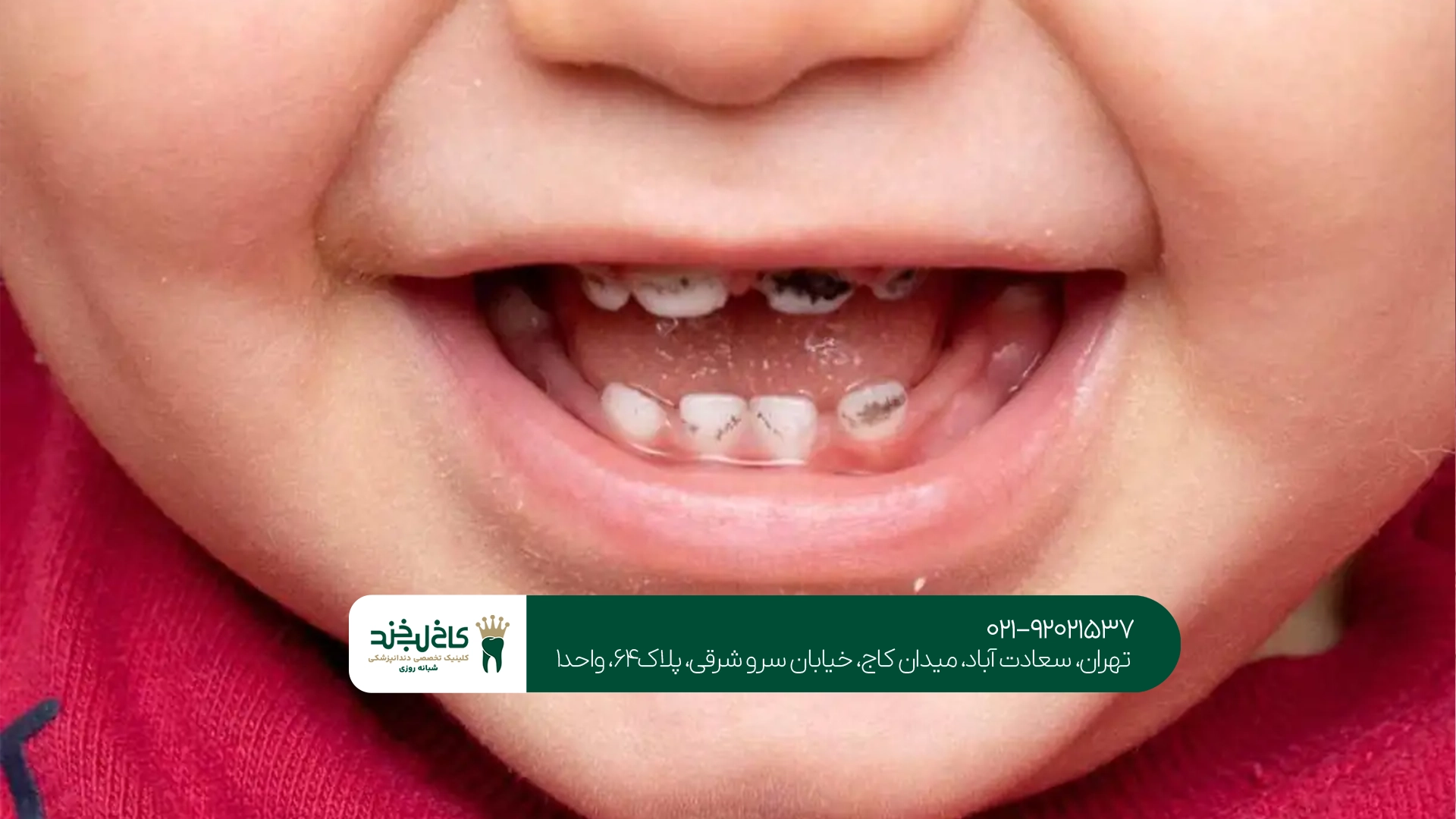 درمان دندان شیری پوسیده
