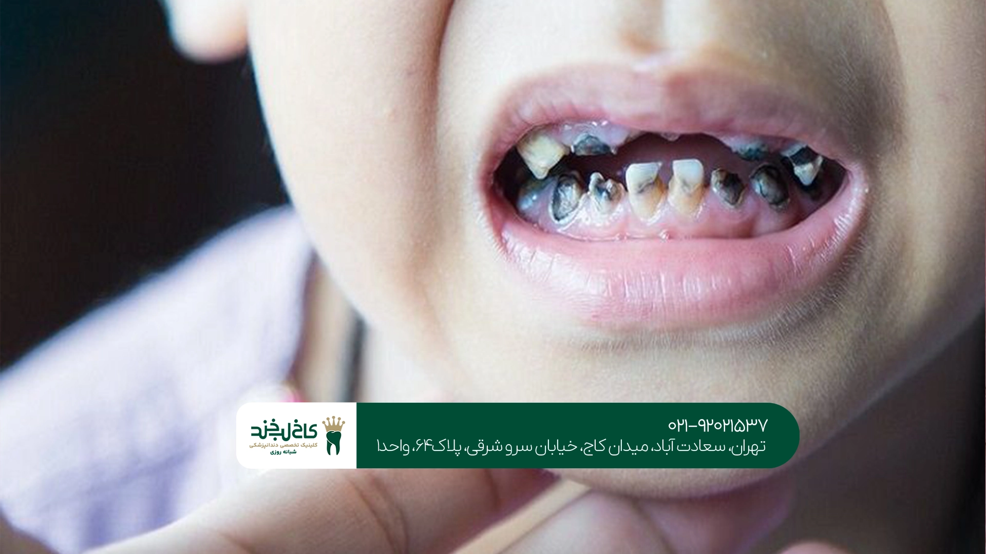 چگونه از پوسیدگی دندان کودکان پیشگیری کنیم؟
