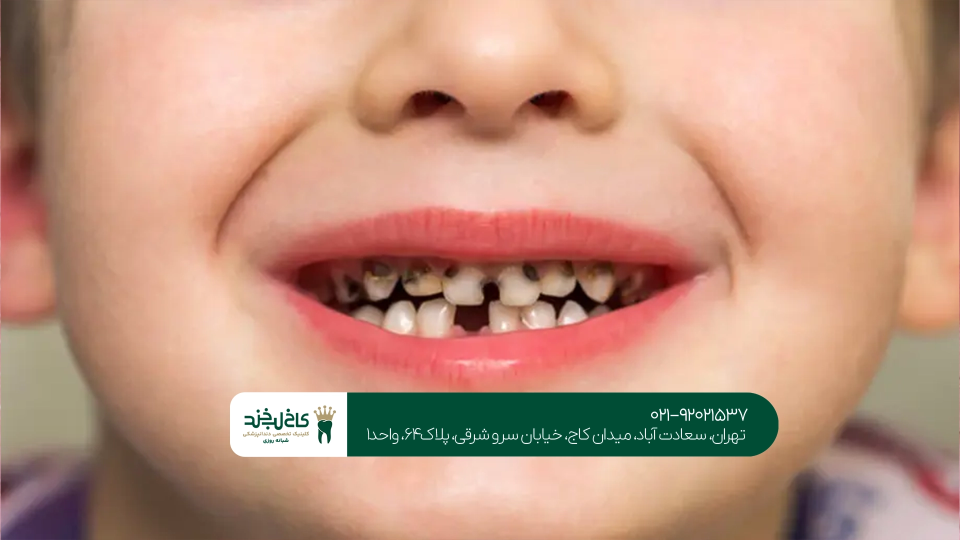 علت پوسیدگی زودرس دندانهای شیری در کودکان چیست؟