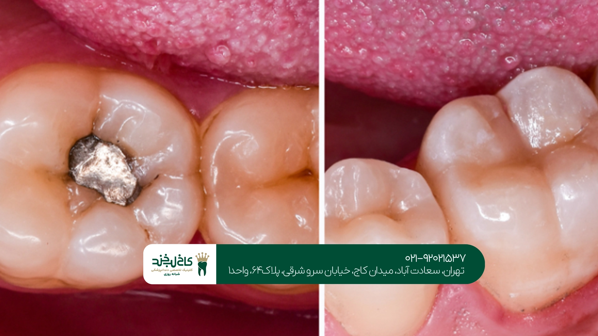 کلینیک تخصصی درمان پوسیدگی دندان