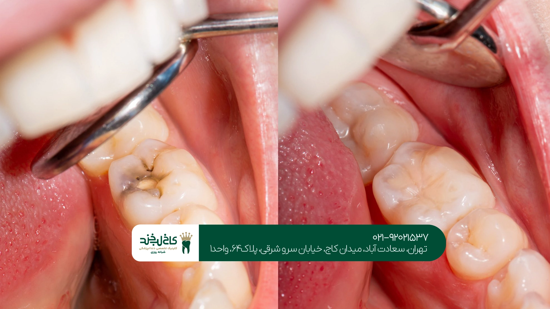 آیا پوسیدگی عمیق دندان بدون عصبکشی درمان میشود؟