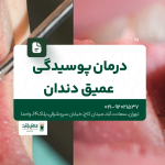 درمان پوسیدگی عمیق دندان