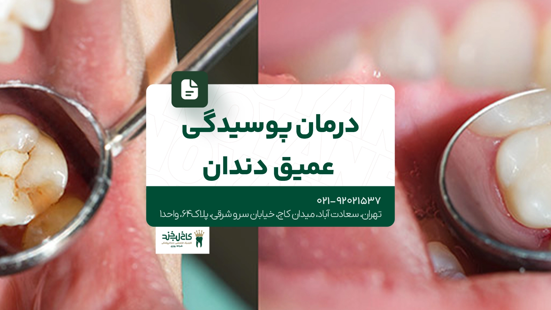 درمان پوسیدگی عمیق دندان