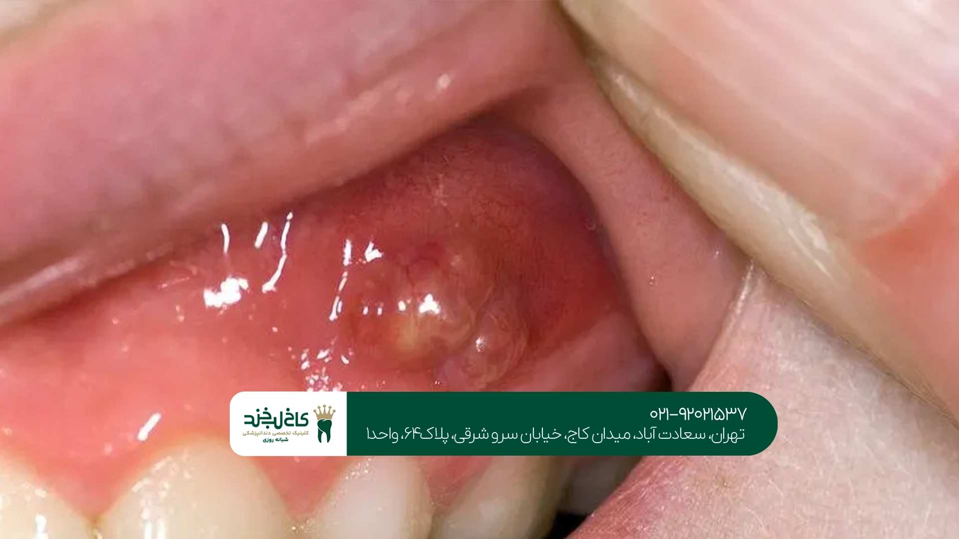 متخصص درمان کیست دندان