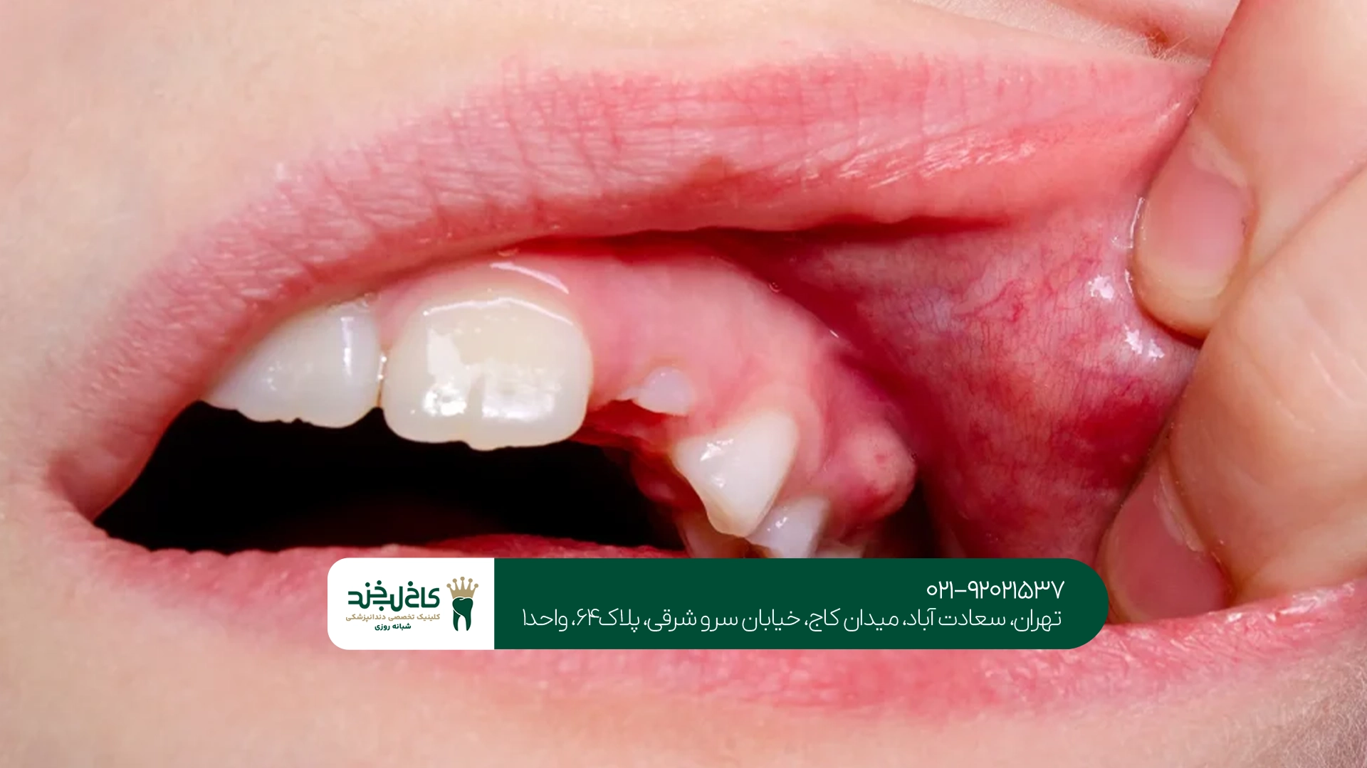 بهترین مرکز درمان کیست دندان