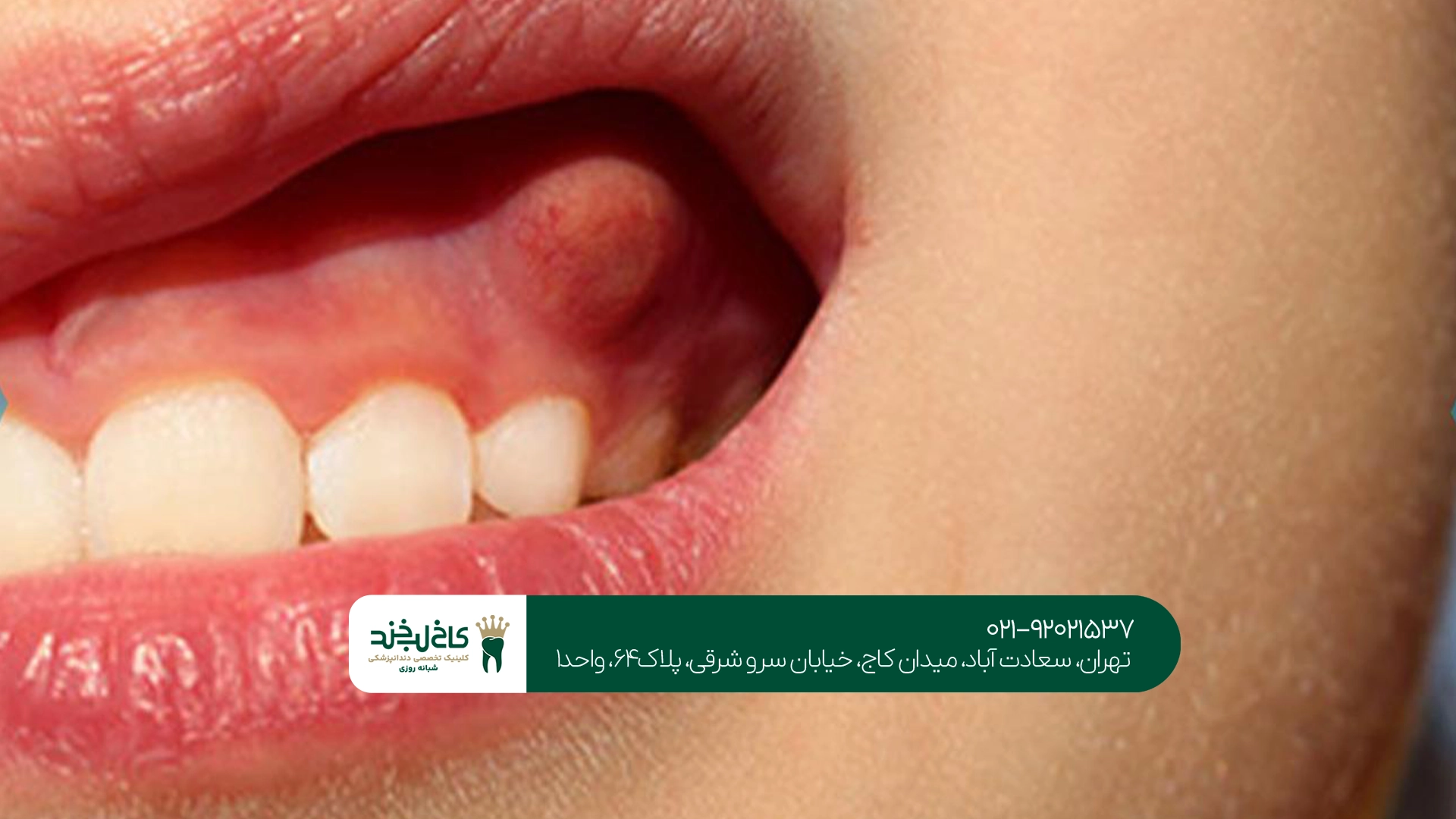 آیا کیست دندان بدون جراحی درمان میشود؟