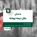دندان عقل نیمه نهفته