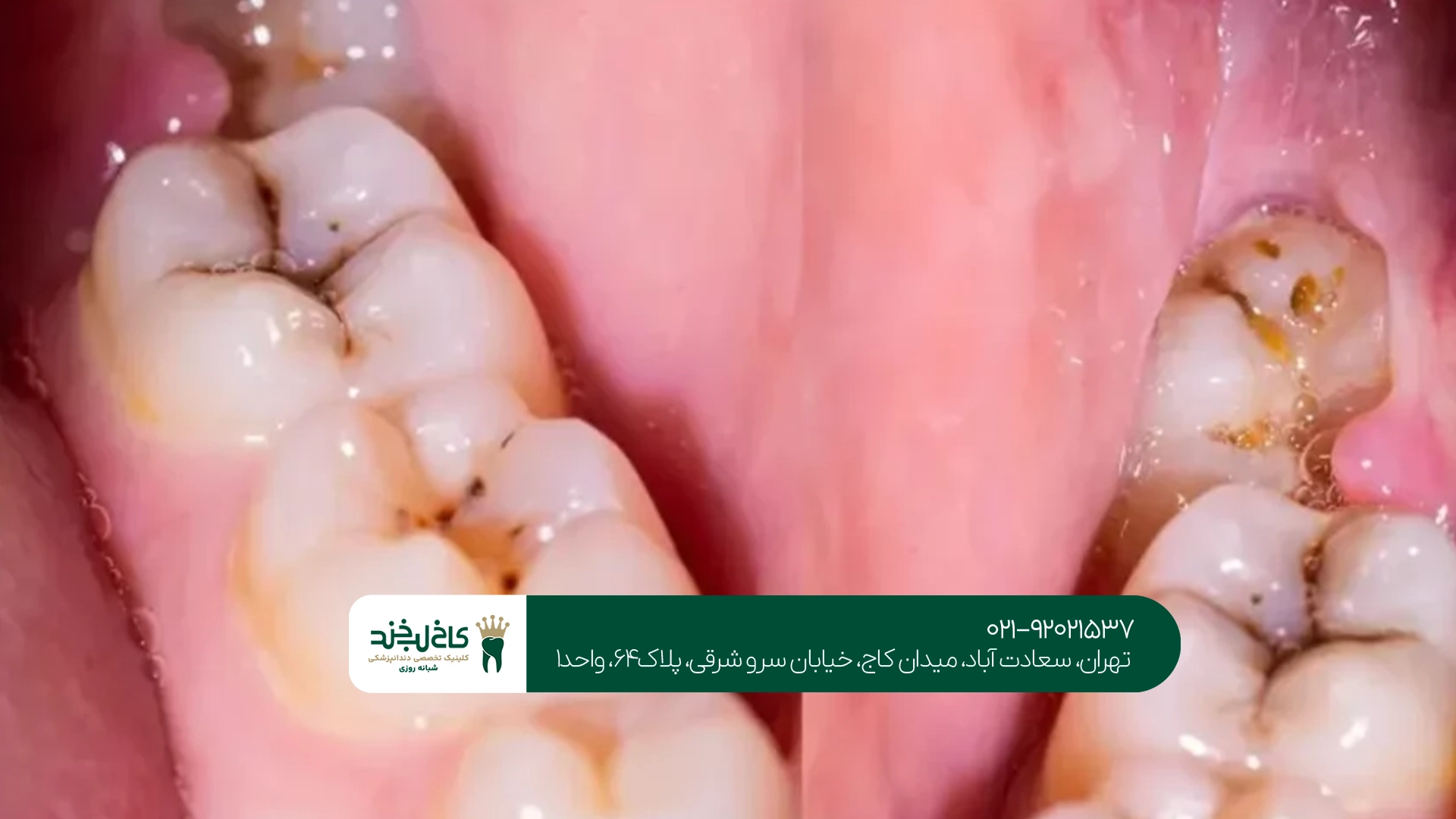 علائم دندان عقل نیمه نهفته علائم دندان عقل نیمه نهفته