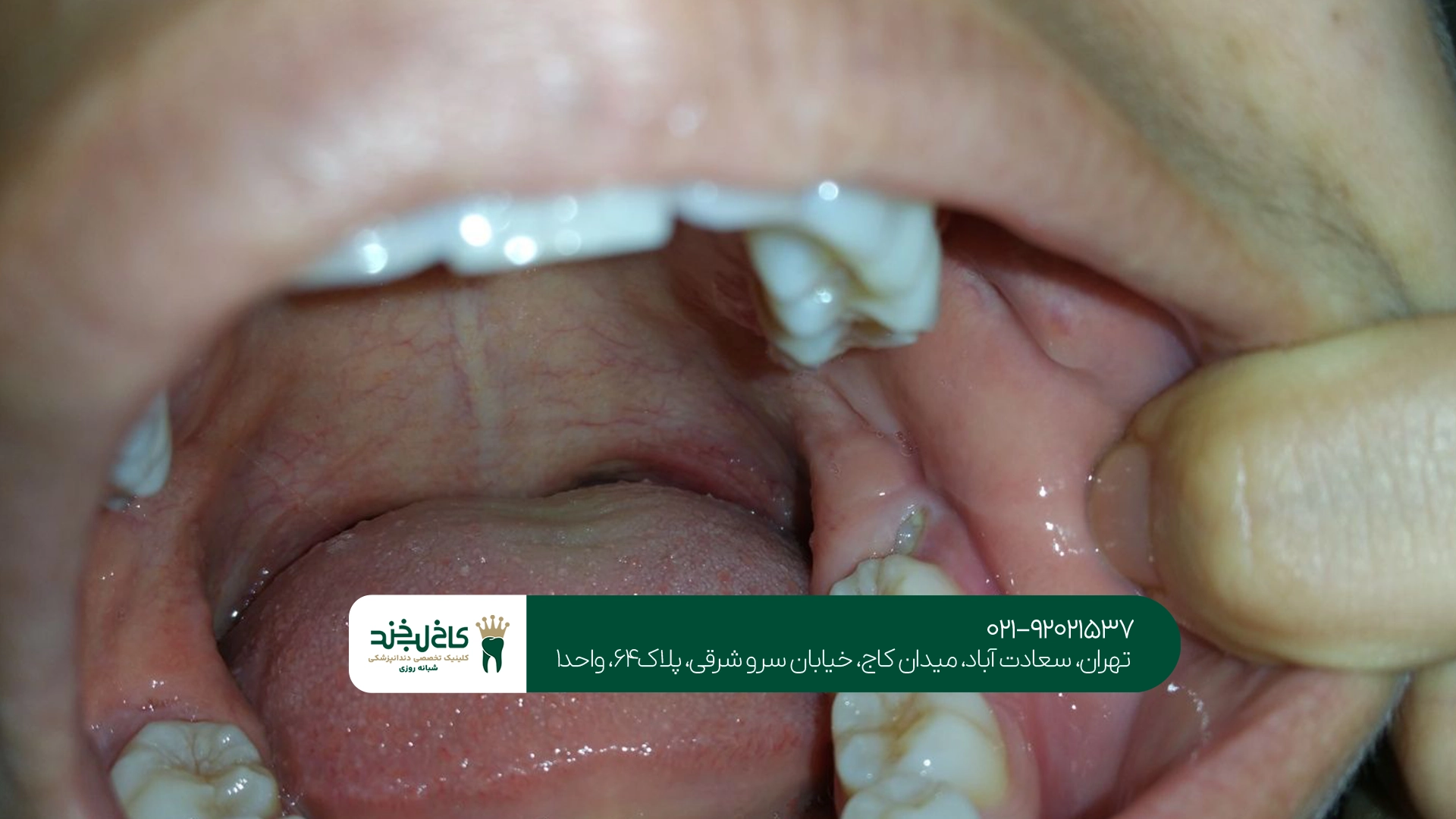 جراحی دندان عقل نیمه نهفته در تهران جراحی دندان عقل نیمه نهفته در تهران