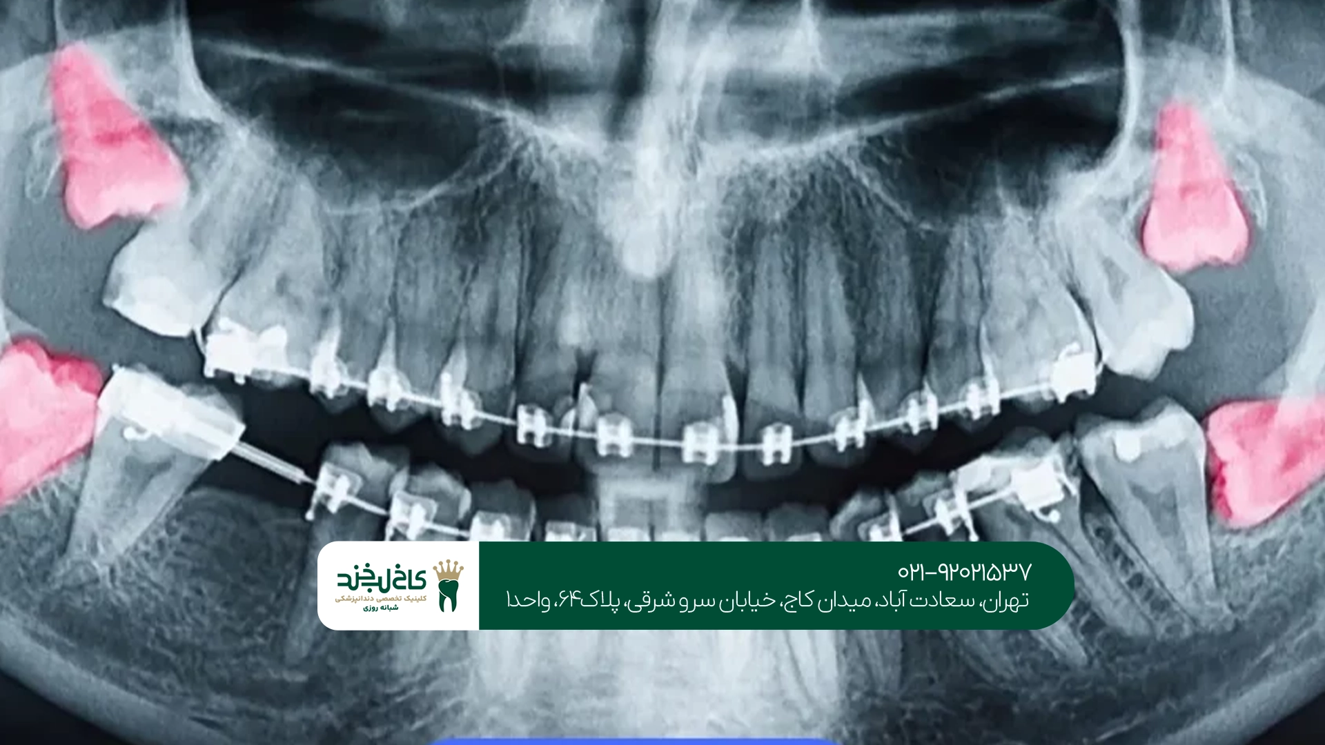 هزینه جراحی دندان عقل نیمه نهفته هزینه جراحی دندان عقل نیمه نهفته