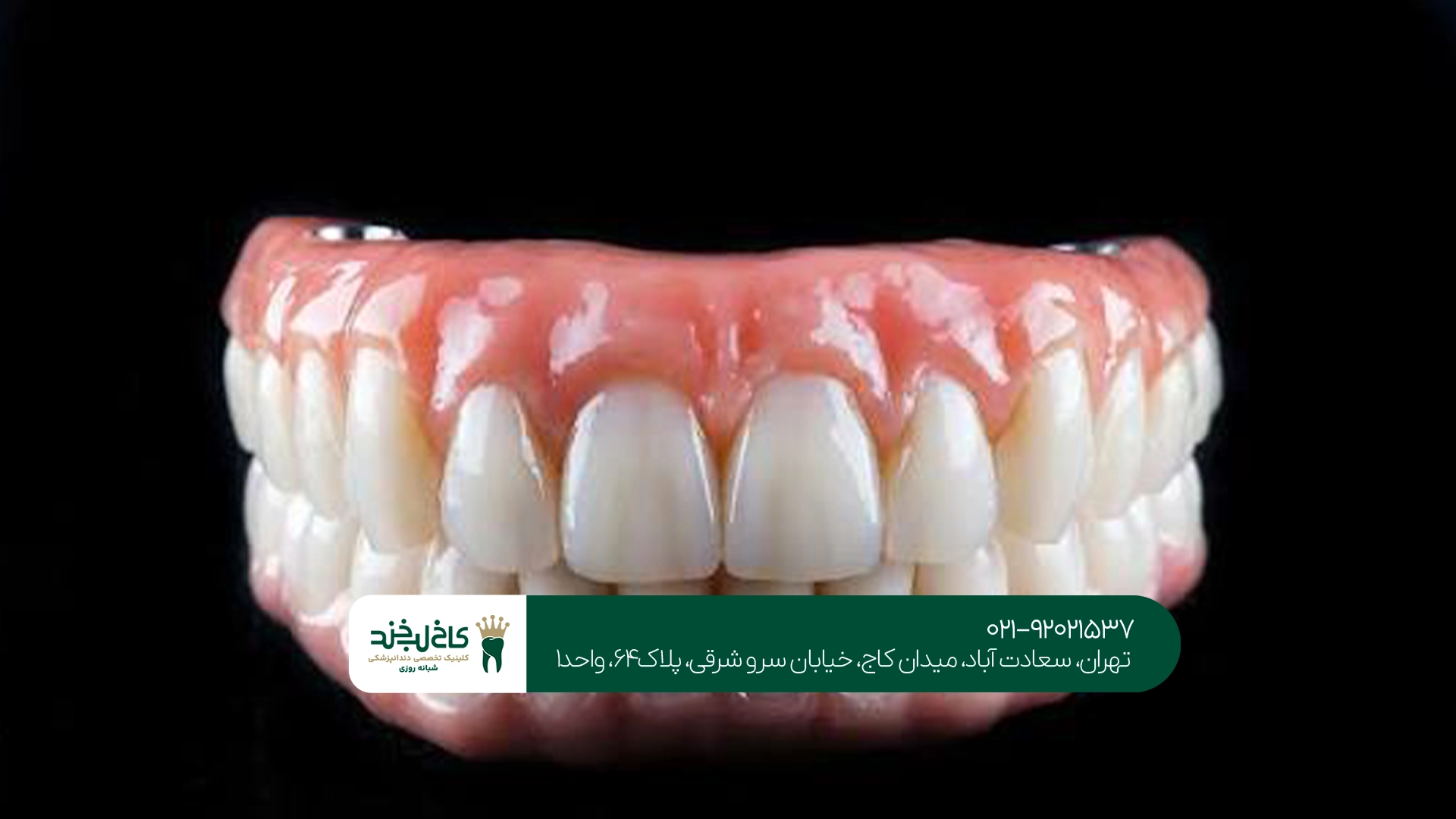 مراقبتهای بعد از نصب دندان مصنوعی ثابت