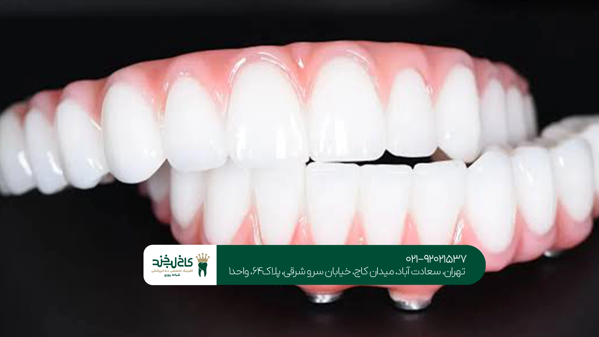 مراقبتهای بعد از نصب دندان مصنوعی ثابت