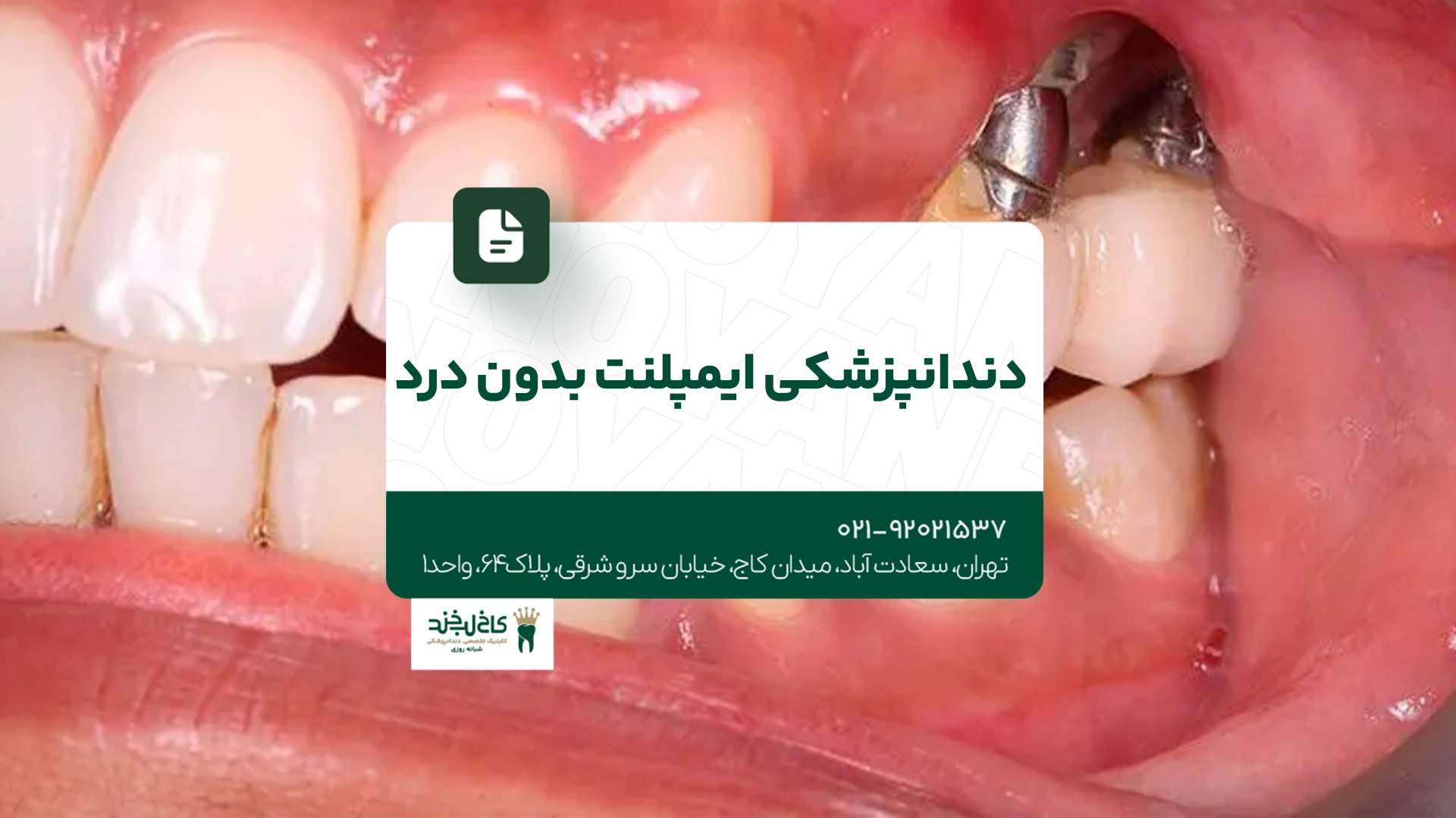 دندانپزشکی ایمپلنت بدون درد دندانپزشکی ایمپلنت بدون درد
