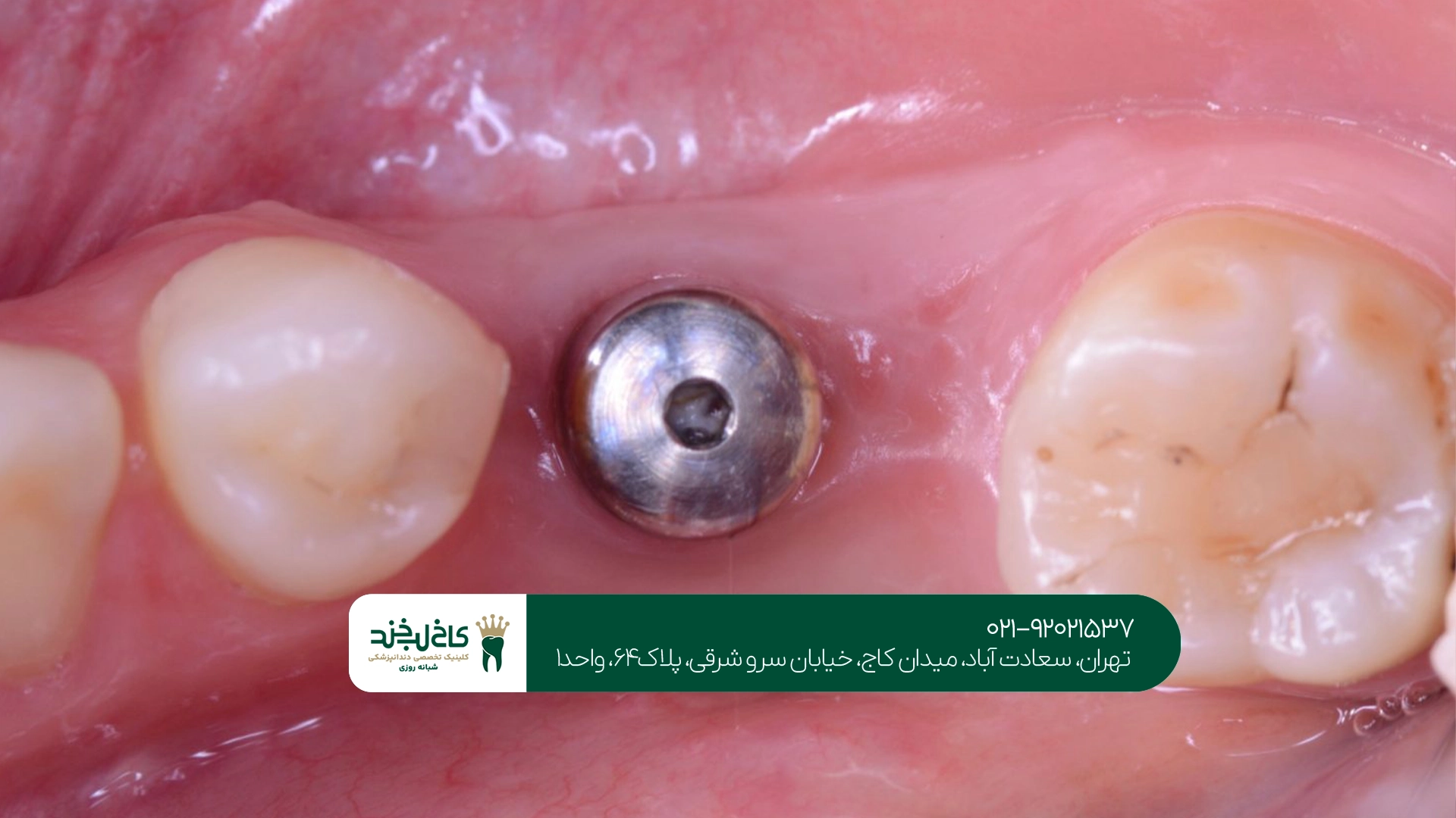 دندانپزشکی ایمپلنت دندانپزشکی ایمپلنت