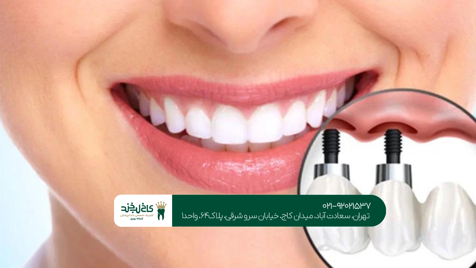 متخصص ایمپلنت بدون درد متخصص ایمپلنت بدون درد