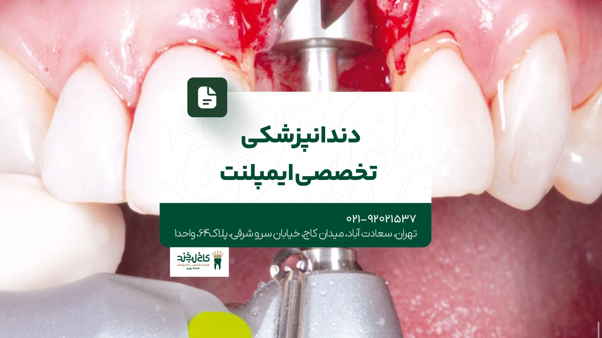 دندانپزشکی تخصصی ایمپلنت