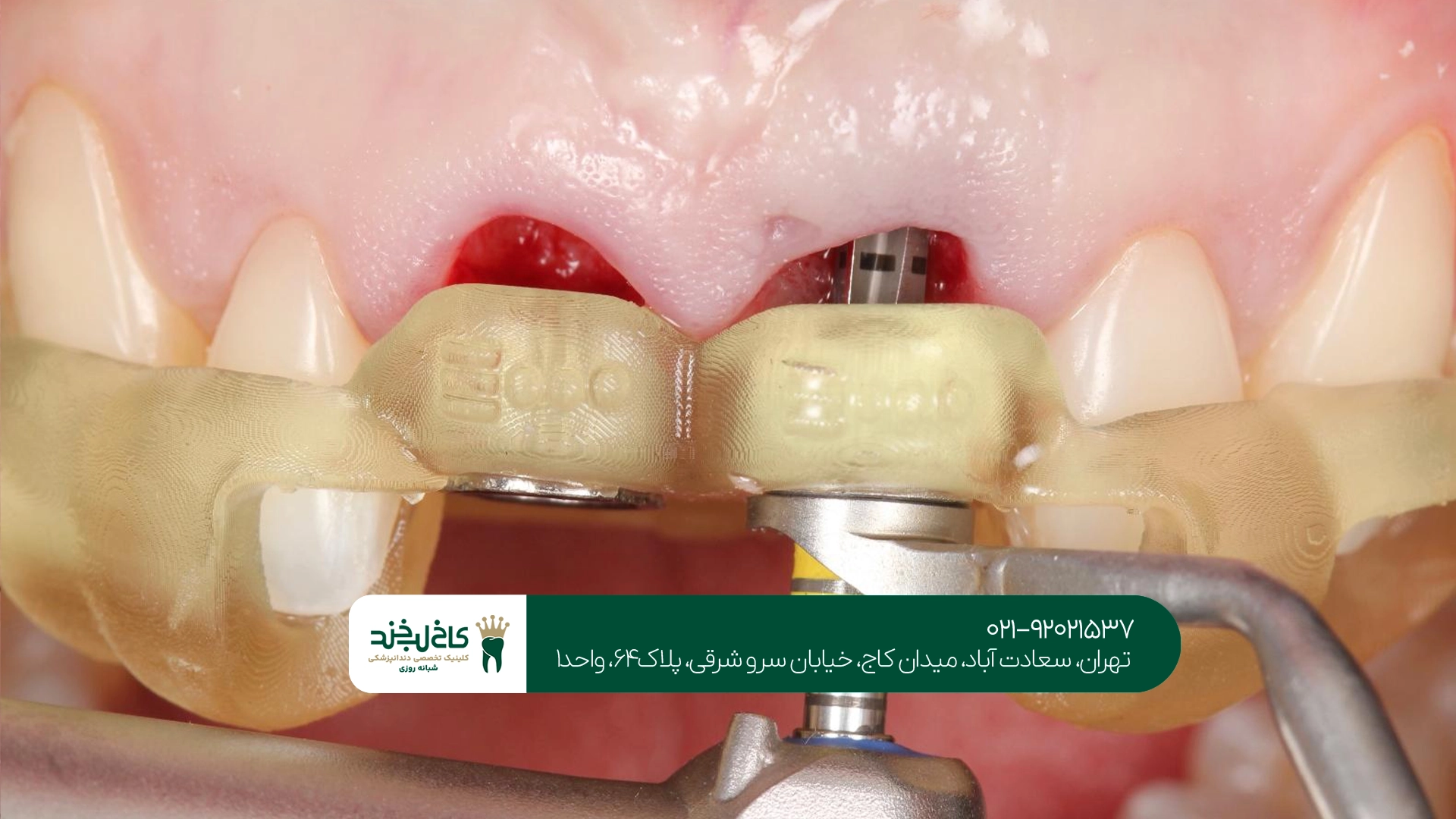 ایمپلنت تخصصی دندان در تهران